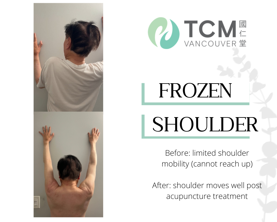 Frozen Shoulder.png