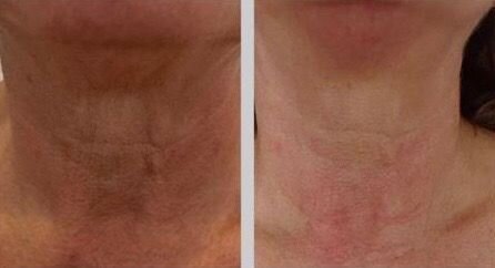 Neck Rejuvenation Before &amp; After in just 1 Session! ✨ Unlock the secret to a more youthful neck! 😍 Our Tecartherapy 2nd Generation Radio Frequency skin tightening treatment is designed to target and firm the delicate skin around your neck. 🌸💁&