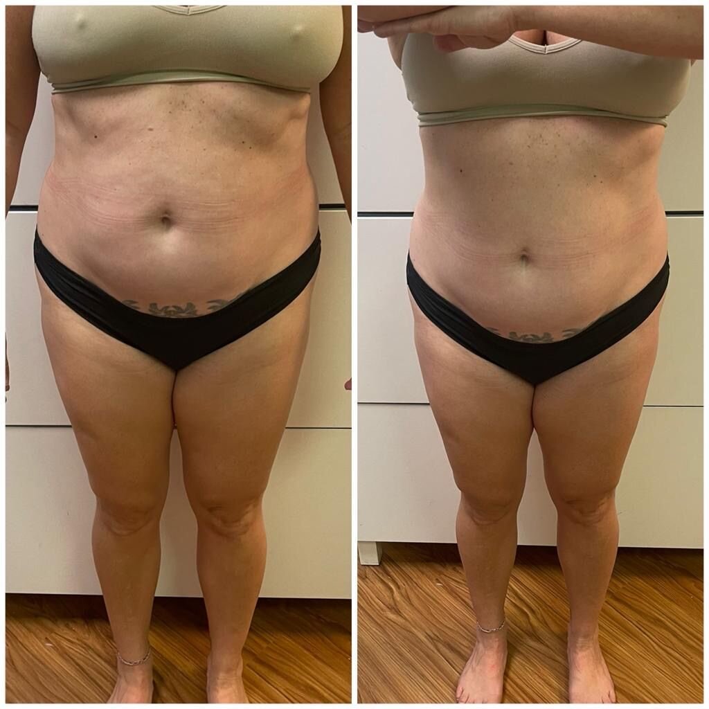 Before &amp; After in just 2 sessions burning subcutaneous and visceral fat, using our amazing second generation TECAR equipment! ⚡️ With the latest technology of the Capenergy Radiofrequency we can focus on abdomen reduction, reducing skin sagginess