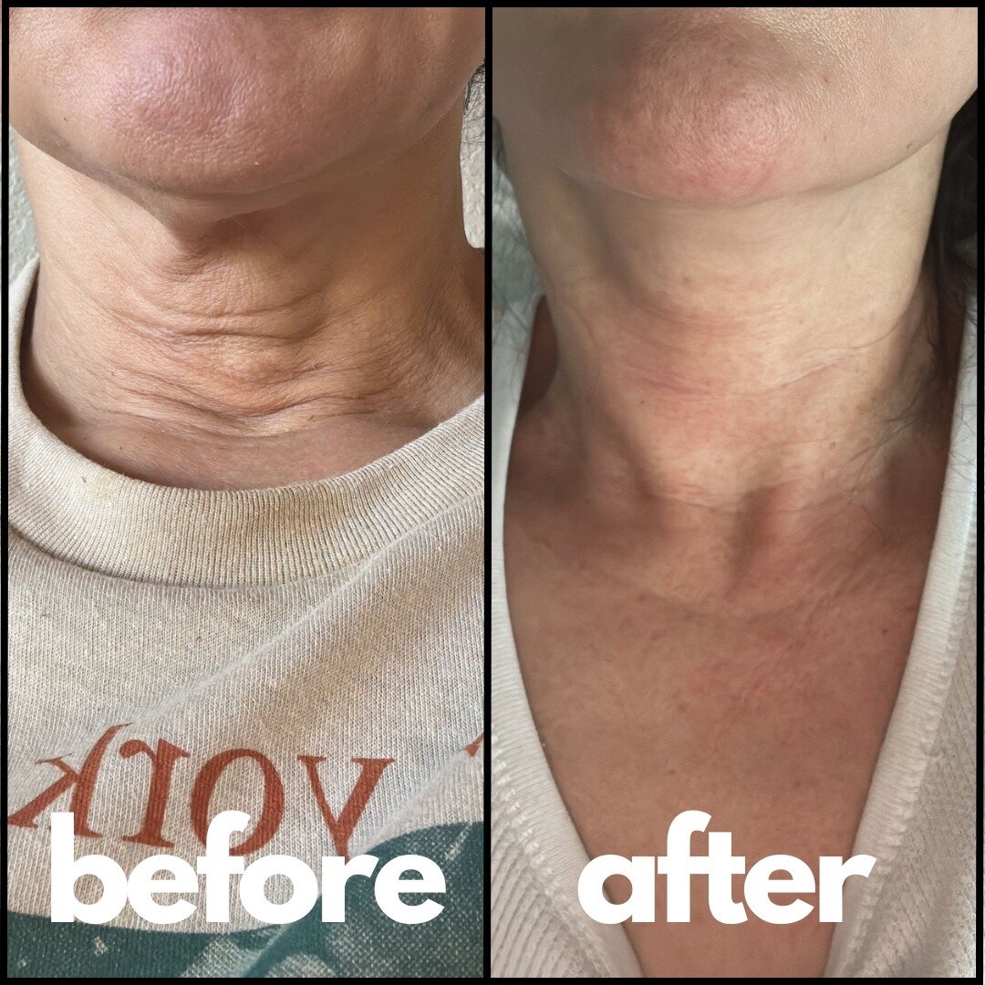 The most popular anti-aging facial treatments covering the face and the neck (d&eacute;colletage)!✨😍 DON'T MISS THIS AMAZING TREATMENTS &amp; DEALS FOR YOUR FACE &amp; NECK (D&Eacute;COLLETAGE)! We have amazing choices valued in $300+ for ONLY $149.