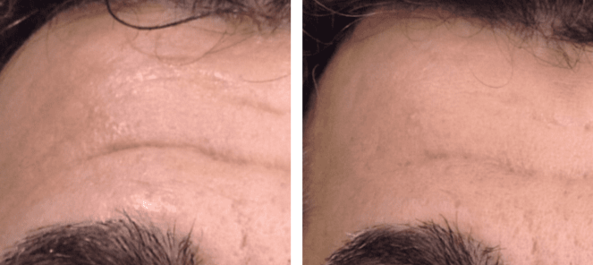 dermaroller+-+forehead+wrinkles.png