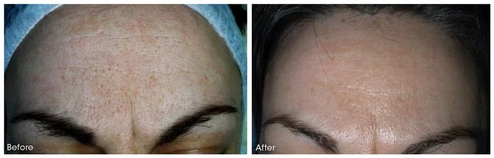 Dermaroller-IcePick and frown lines.jpg