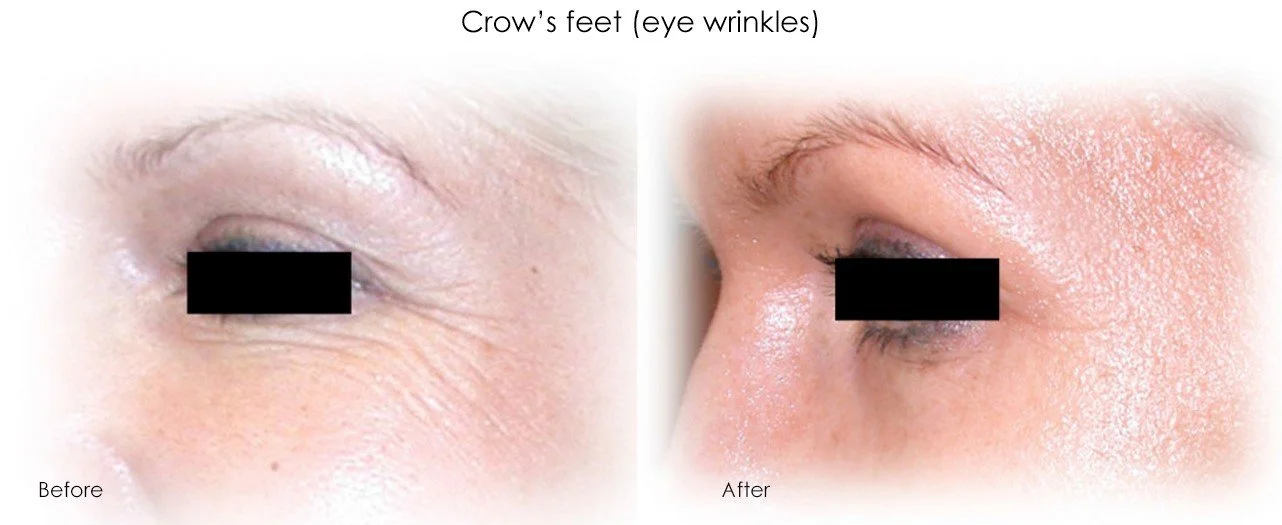 dermaroller - crows feet.jpg