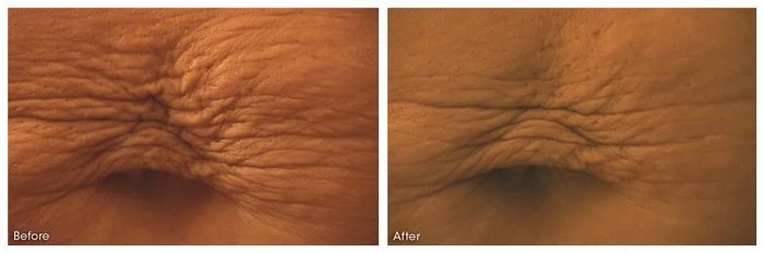 dermaroller-stretch-marks-1-WEB.jpg