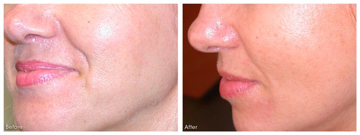 dermaroller- anti aging before and after.jpg