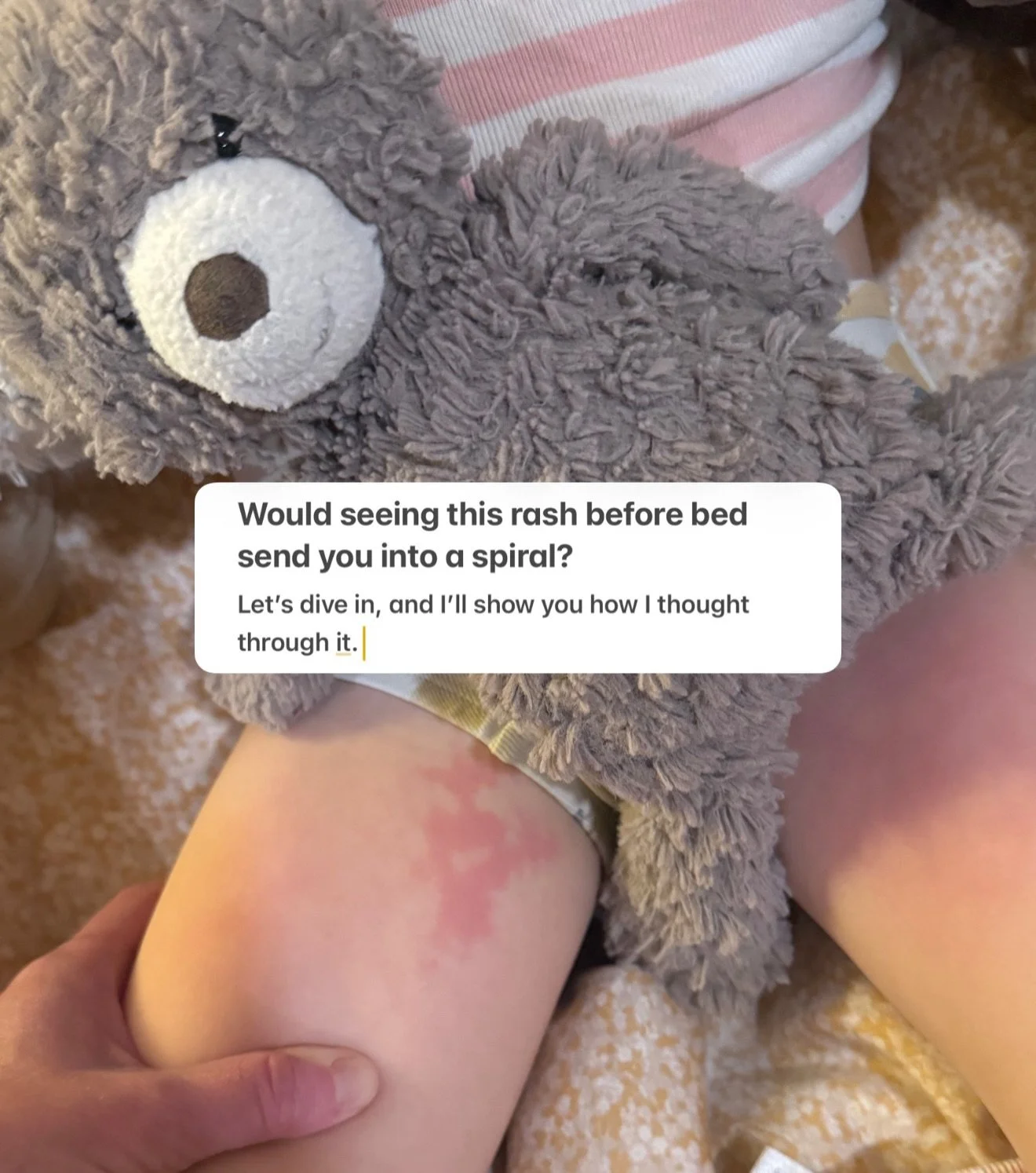 This rash at bedtime would send a lot of parents into a spiral.
Here&rsquo;s how I think it through as a pediatric nurse practitioner.