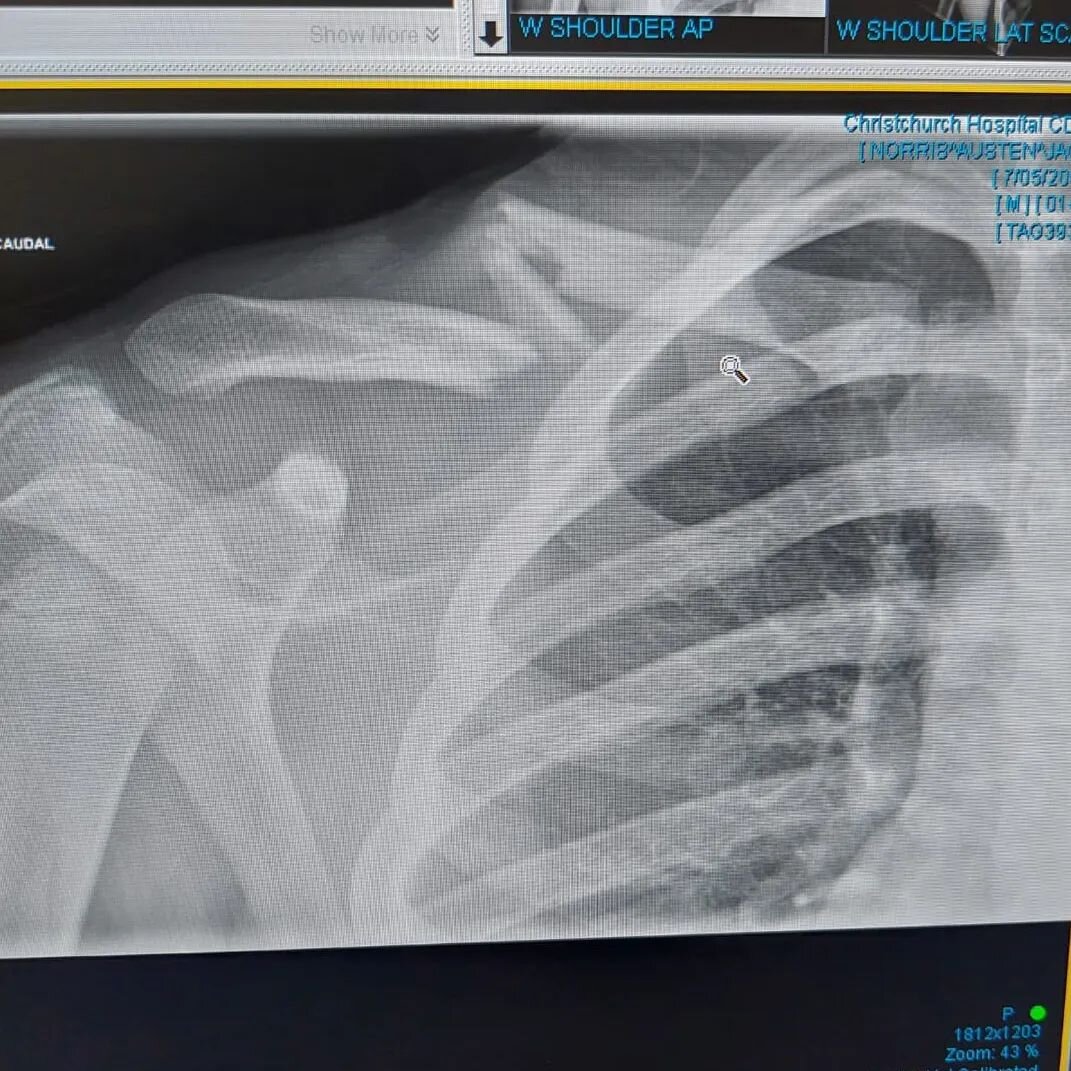 Our man @austen_jack_mtb has errr....reshaped his collarbone!

What do you think he can do over the next 6 weeks on the road to recovery?

Polish his frame? 🤣
Start a religion?
Give free fist bumps to the elderly?

Best advice in the comments wins a