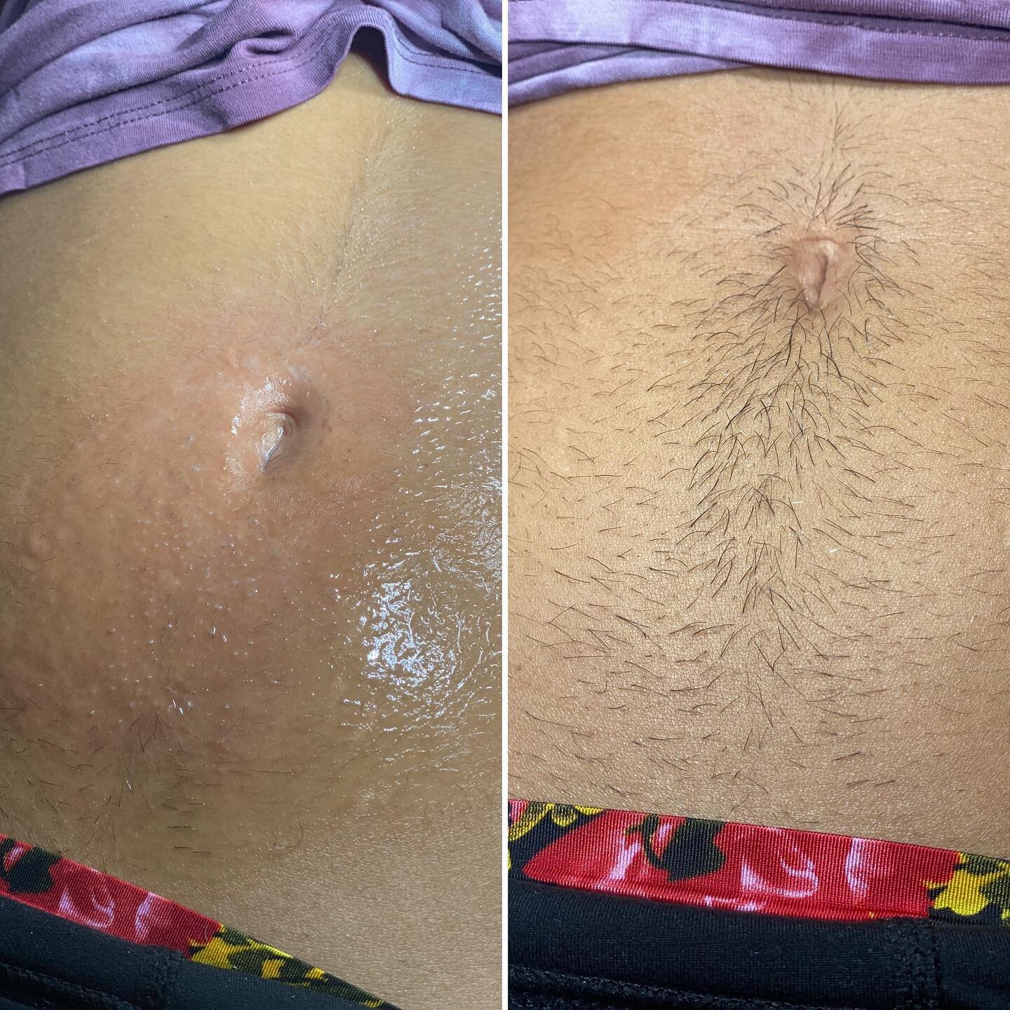 Unwanted abdominal hair?Permanently remove it with a procedure called electrolysis. Electrolysis uses an electric current to kill the hair root and close the follicle. Safe for head to toe body hair removal.
#cthairremoval #electrolysisofwallingford 