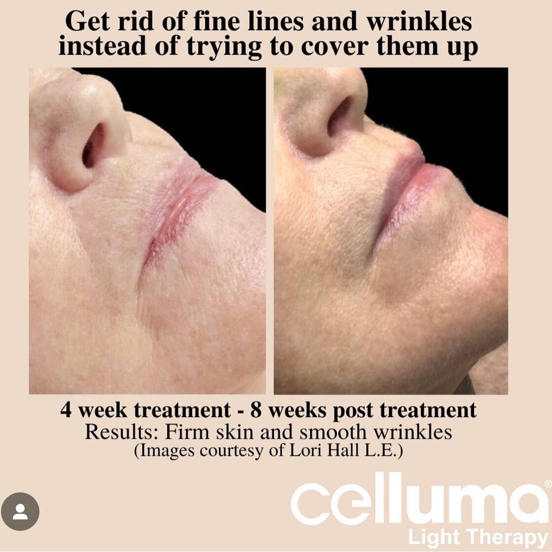 Now offering celluma light therapy in conjunction with micro needling, cosmetic acupuncture or as a stand alone treatment.