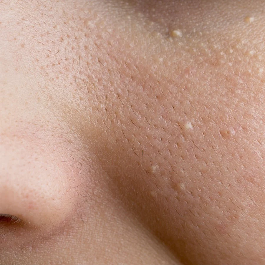 The Mystery of Milia: Those Pesky Little White Bumps