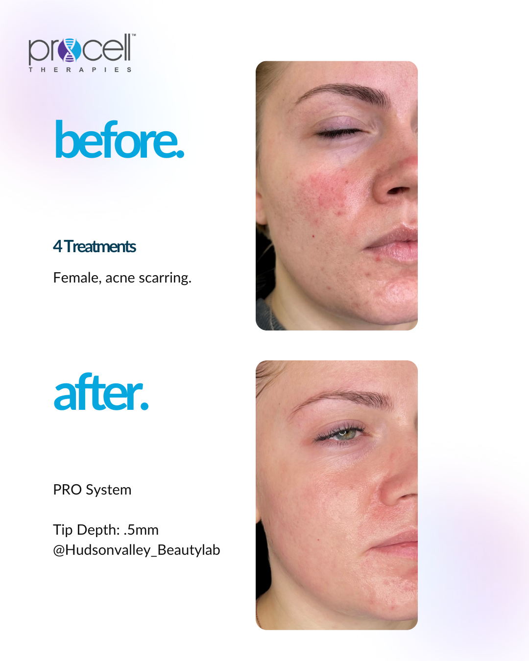 ACNE SCARS.png