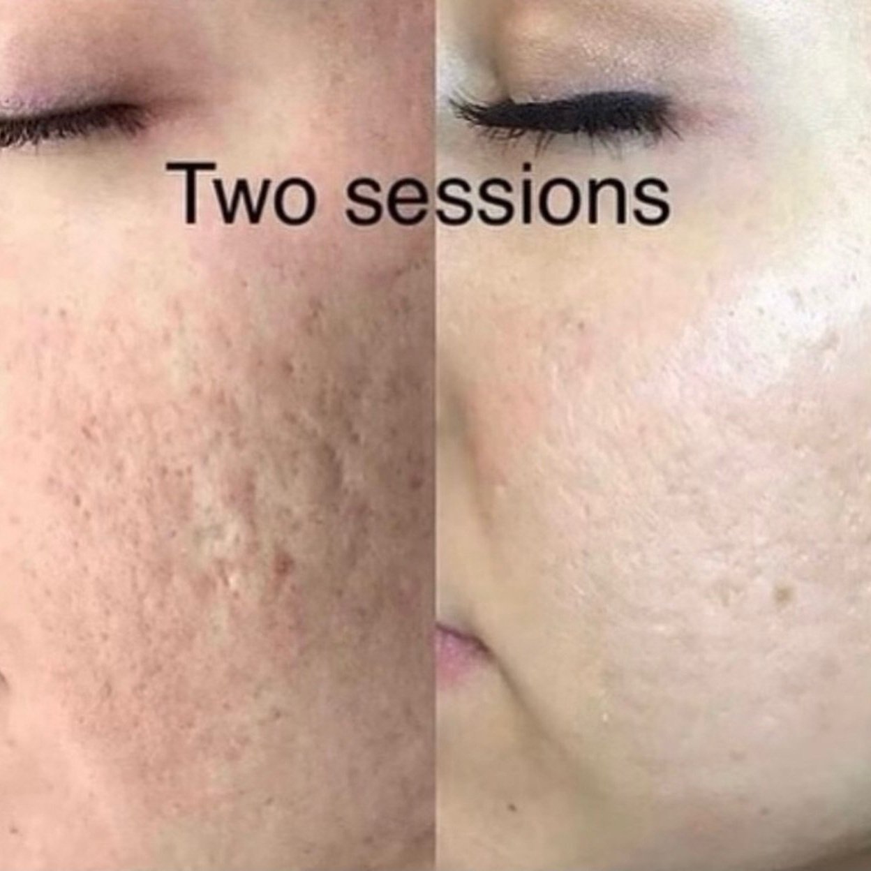 procell-microneedling-lafayette-la.jpg
