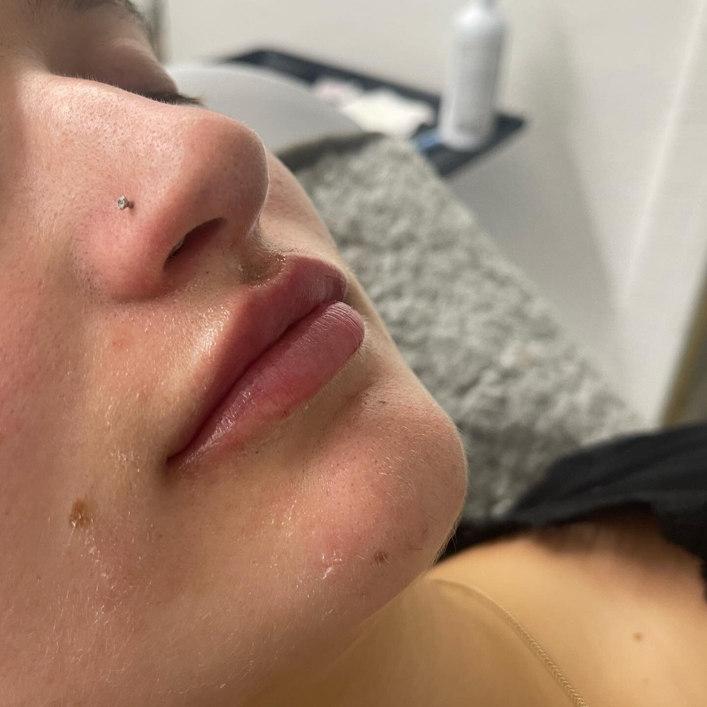 @revanesse ultra really creates the perfect pout 👄 
💉1 syringe lips for this lovely gal 

By Mia Quigley RPN 💉👄
Available in both port carling and Huntsville 

⏱downtime is Minimal some bruising and swelling may occur 
💵 $650 for full syringe 
?