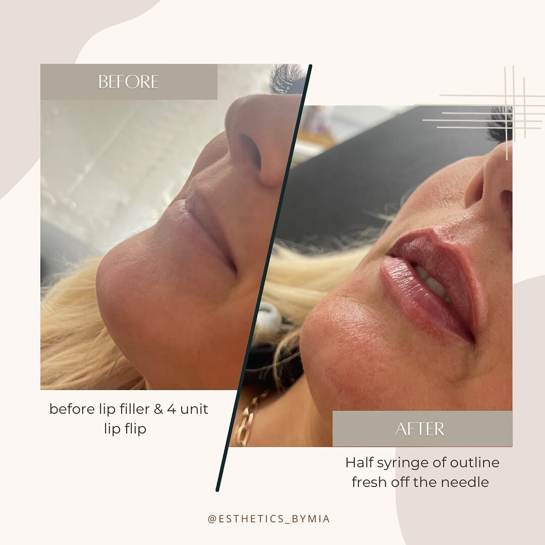 these lips are fresh off the 💉 from a mini lip plump ( aka the half syringe)

Using @revanesse outline to create balance and definition for this lovely lady to create the perfect plump 💋✨ 

👄by Mia Quigley RPN
💵 $350
👩&zwj;⚕️ downtime is minimal