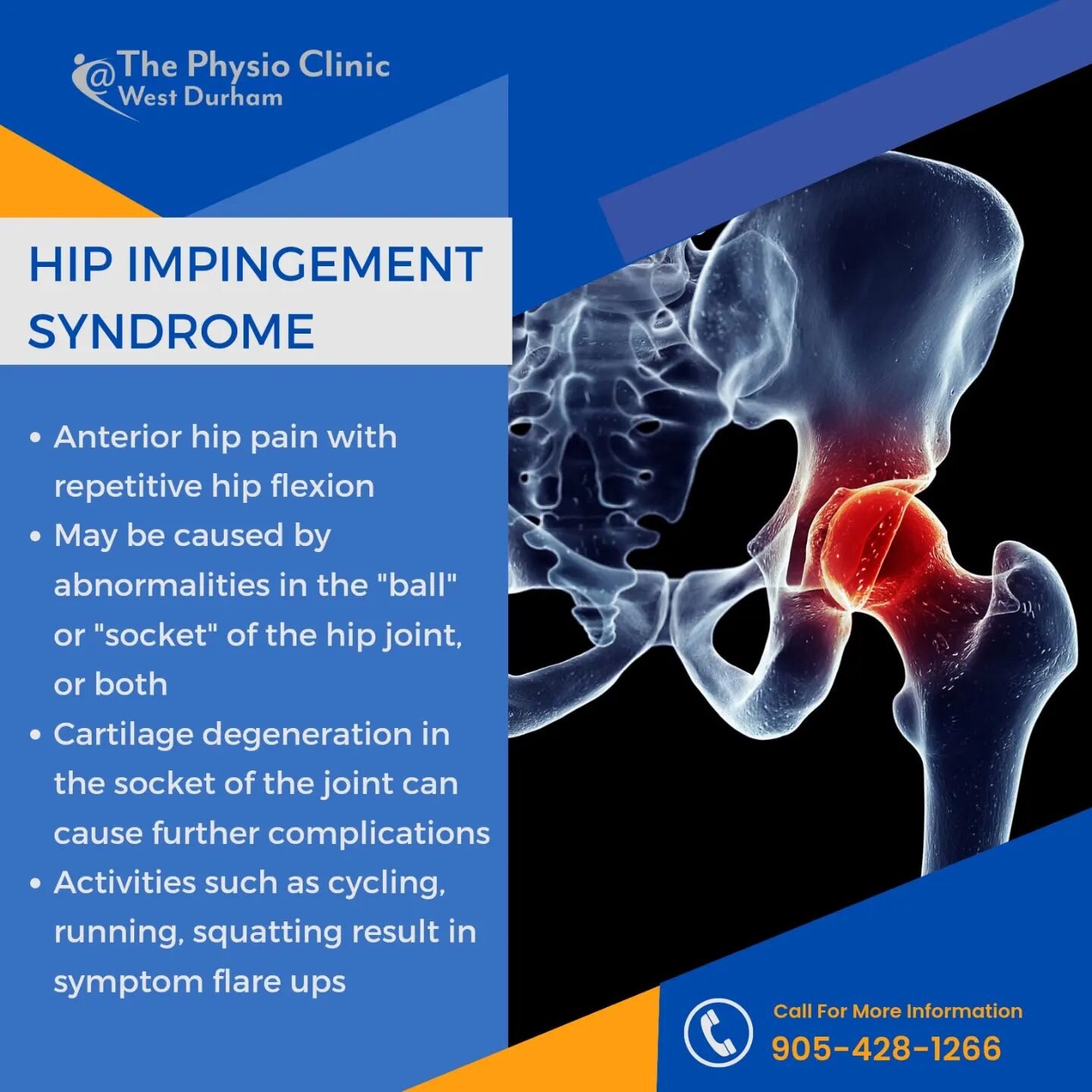 HIP IMPINGEMENT can be a cause of discomfort and hip pain, particularly with repetitive hip flexion. Abnormalities in the &quot;ball and socket&quot; joint of the hip result in this painful condition.

Pain management and rest are important in managi