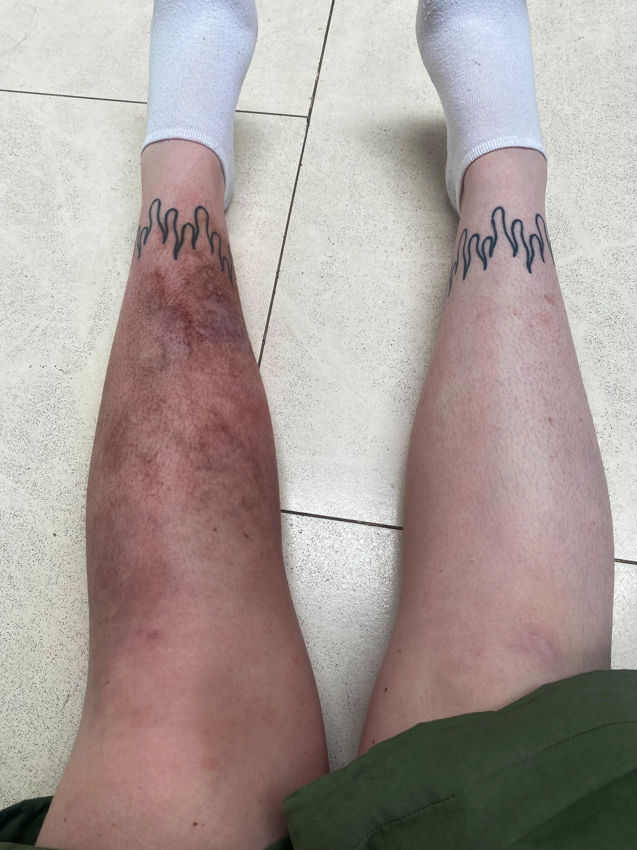 Bruised Leg - Alcohol paints 