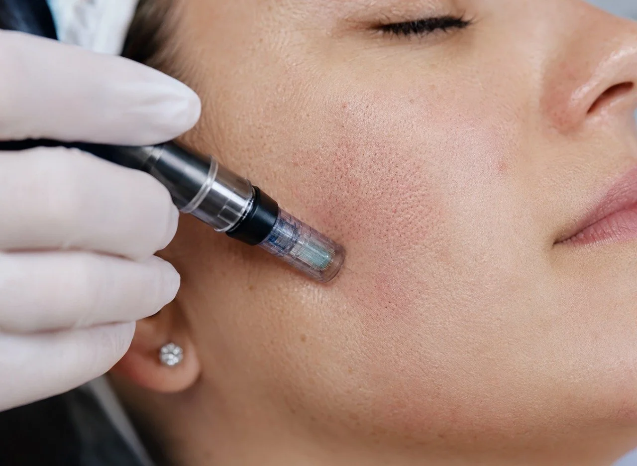 Microneedling for Face in Glendale, AZ: How to Get Firm Skin