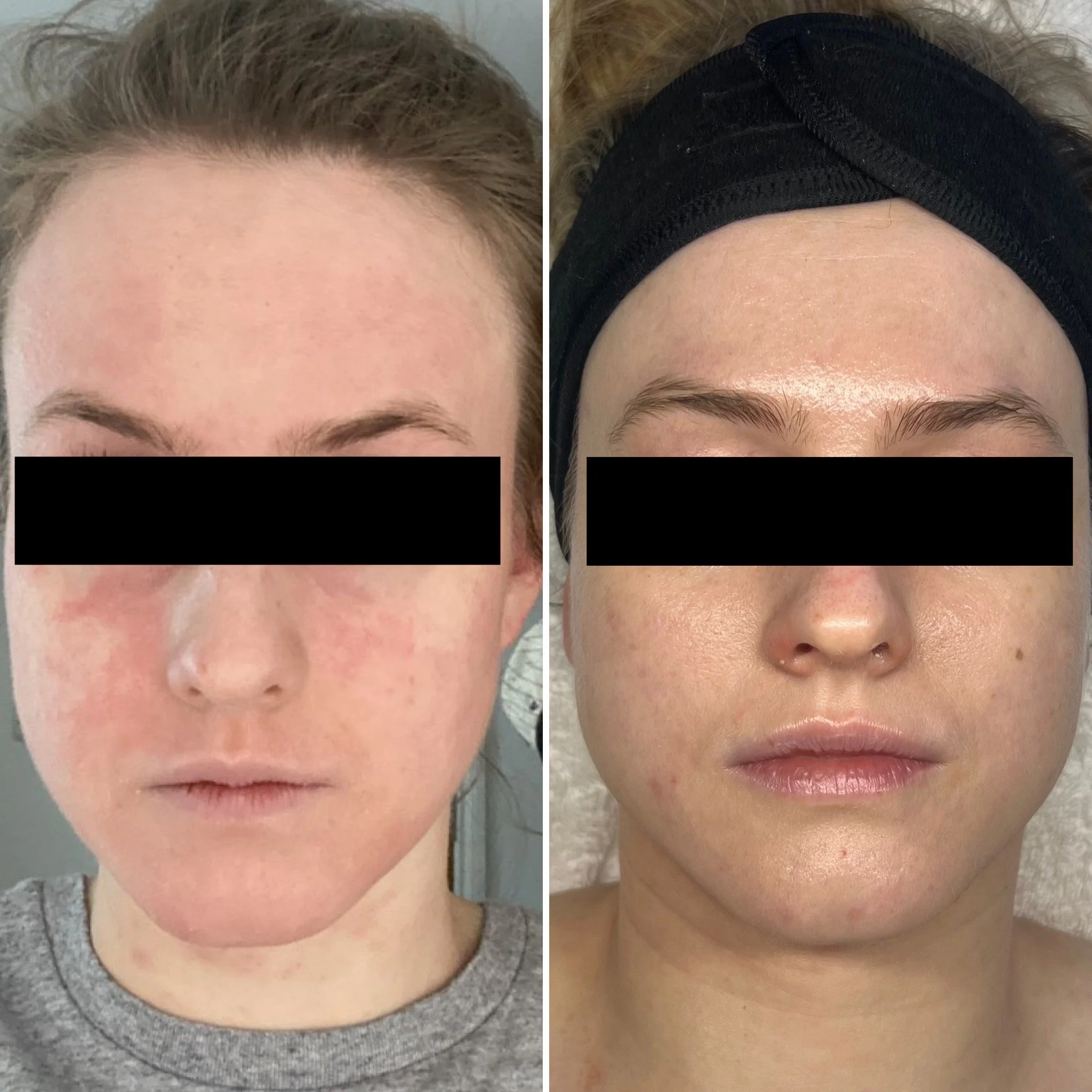 Service: Virtual & This Facial // Timeline: 2+ years (Virtual & 2 x This Facial) // Concerns: Reactive, inflammed skin, redness & dryness