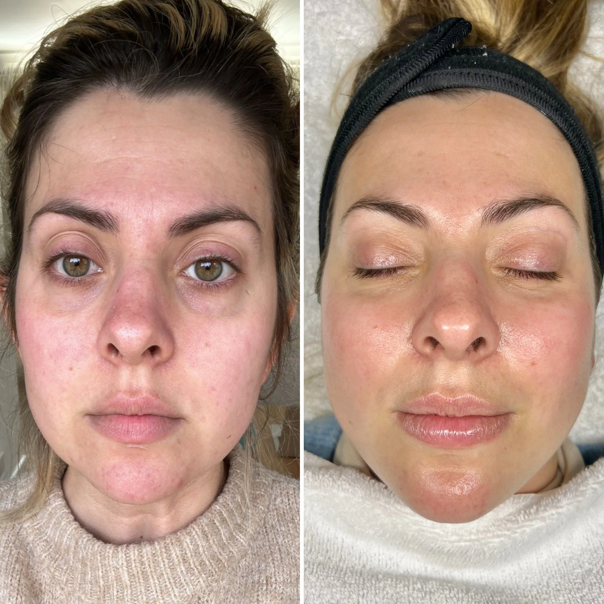 Service: Virtual & This Facial // Timeline: 3 months (2 x Virtual & 1 x This Facial) // Concerns: Dullness, premature ageing & uneven tone