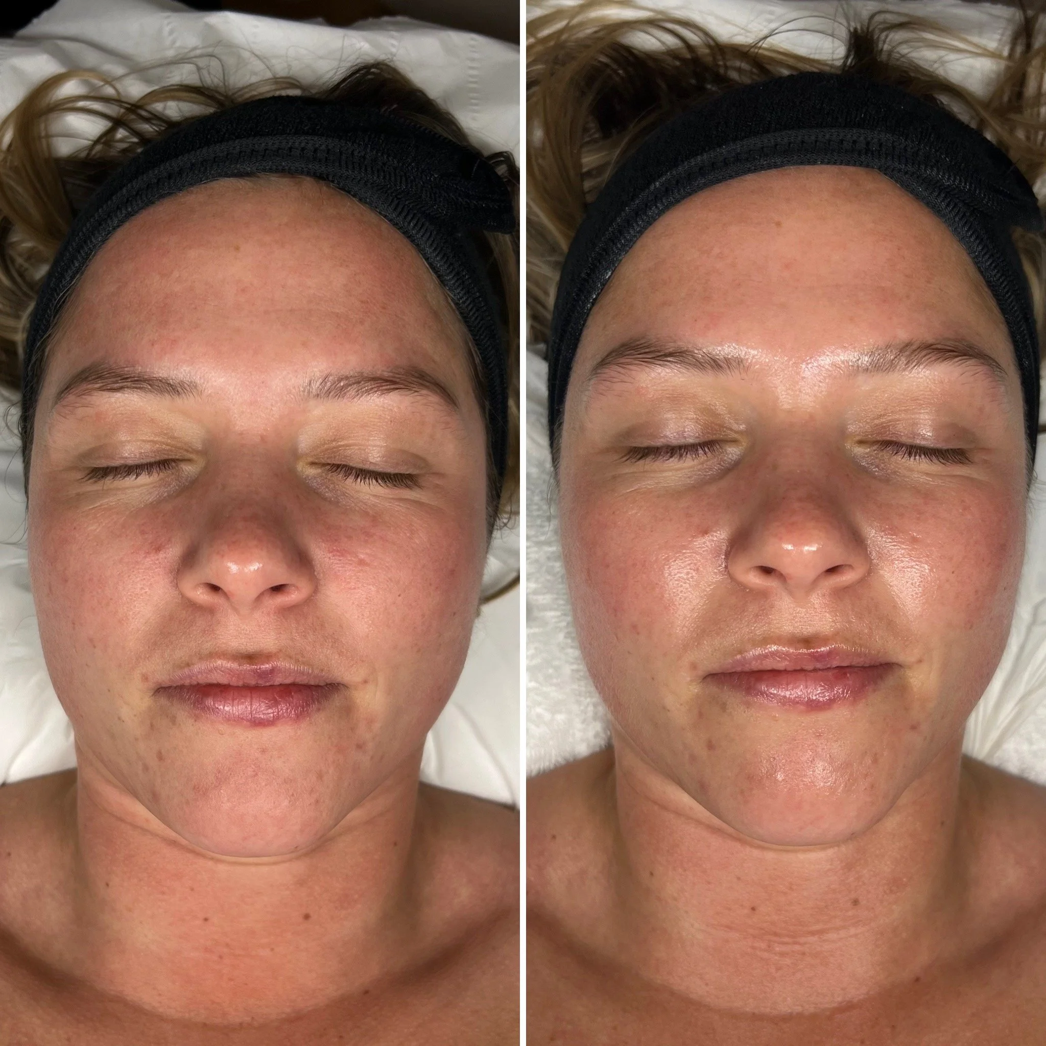 This Facial - Before / After