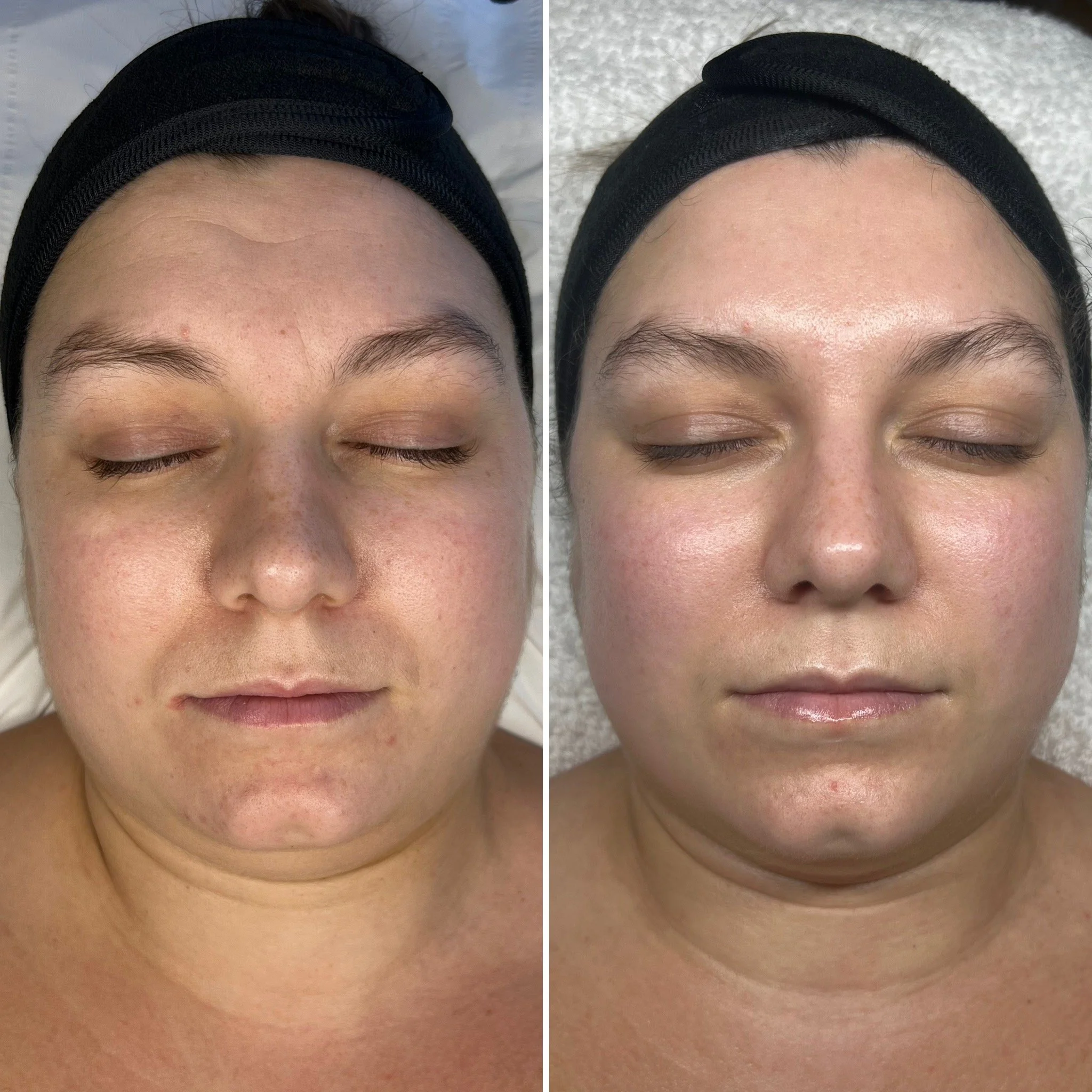Service: This Facial // Timeline: 3 months (one per month) // Concerns: Premature ageing, dullness & wedding skin prep