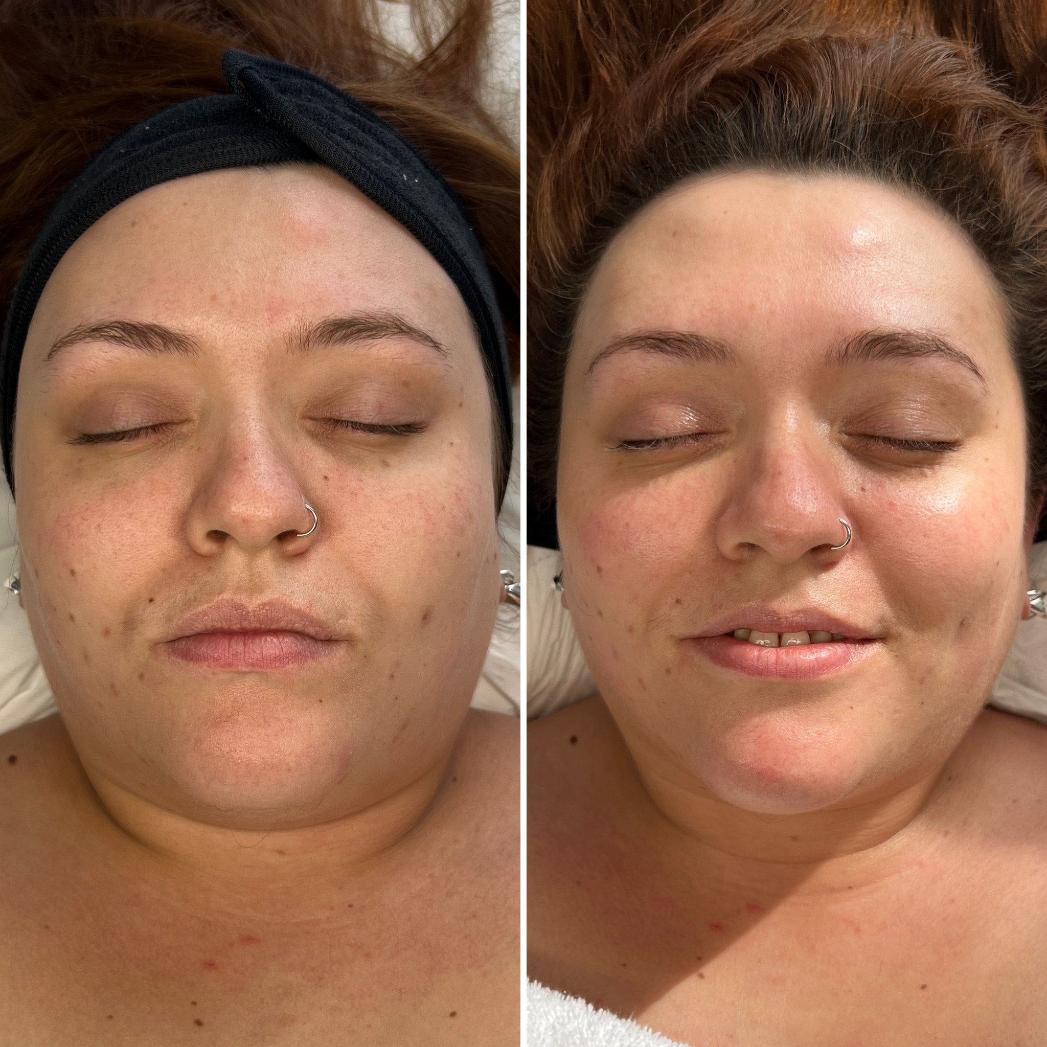 This Facial - Before / After