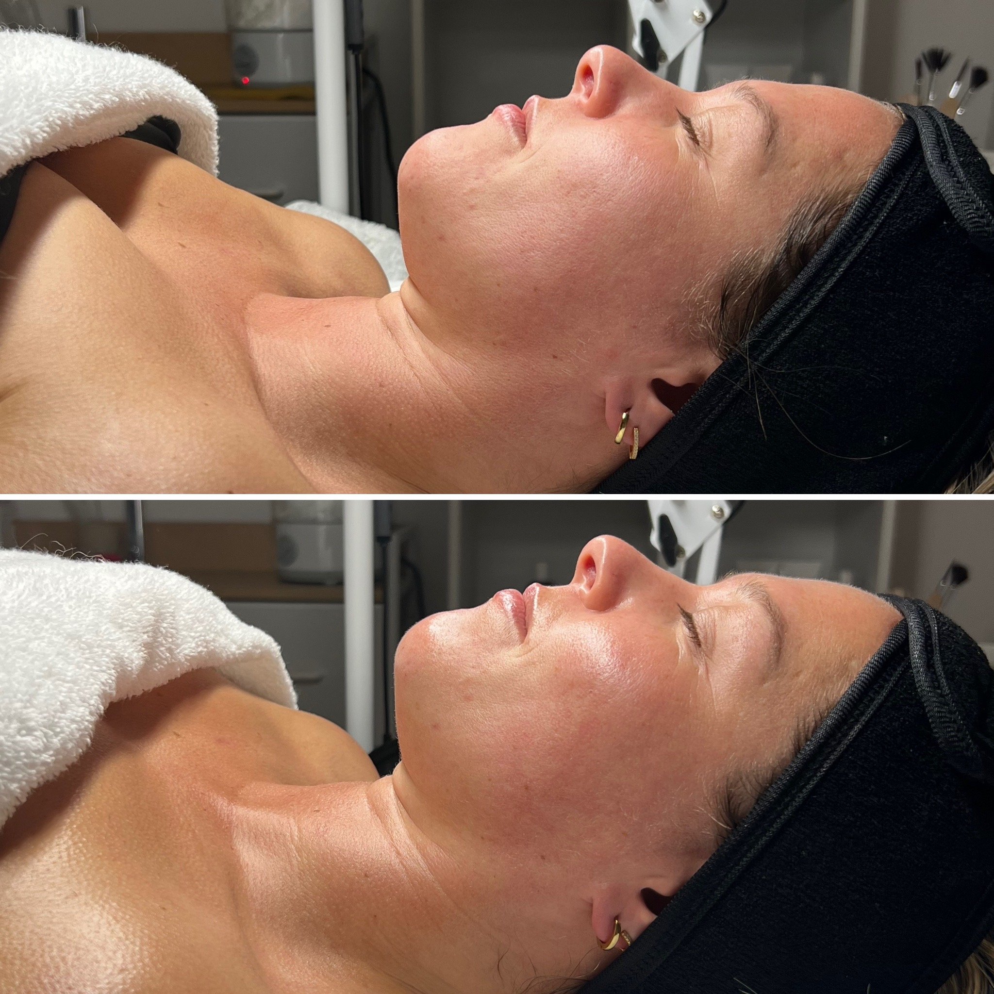 This Facial - Before / After