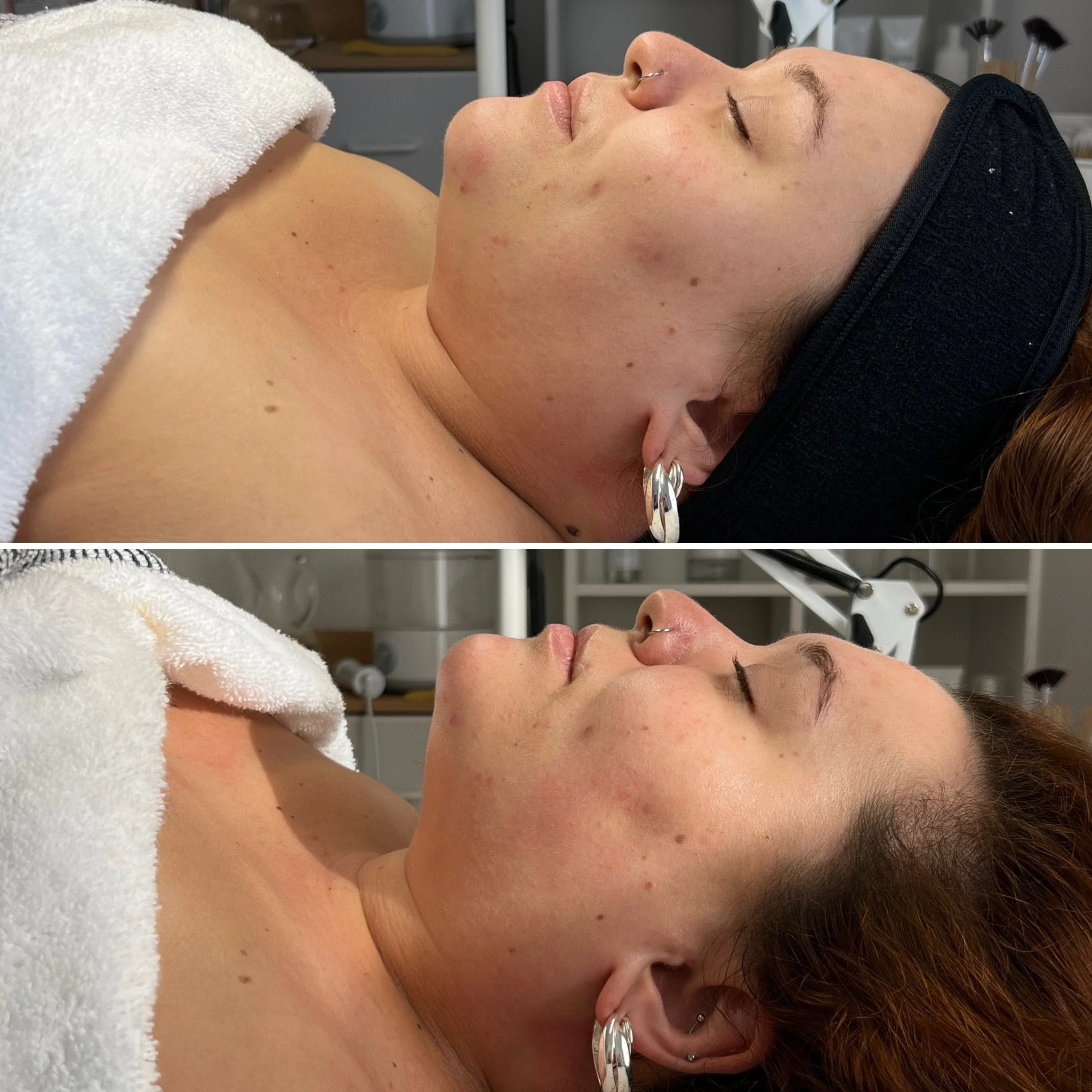 This Facial - Before / After