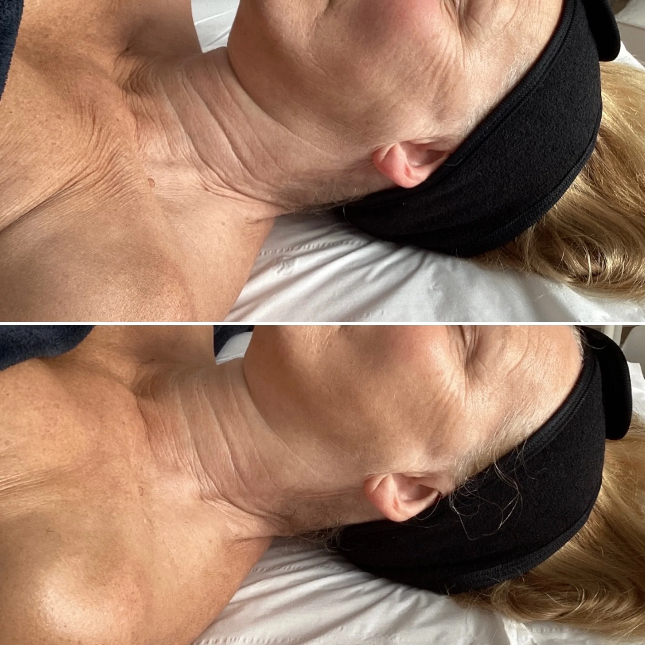 This Facial - Before / After