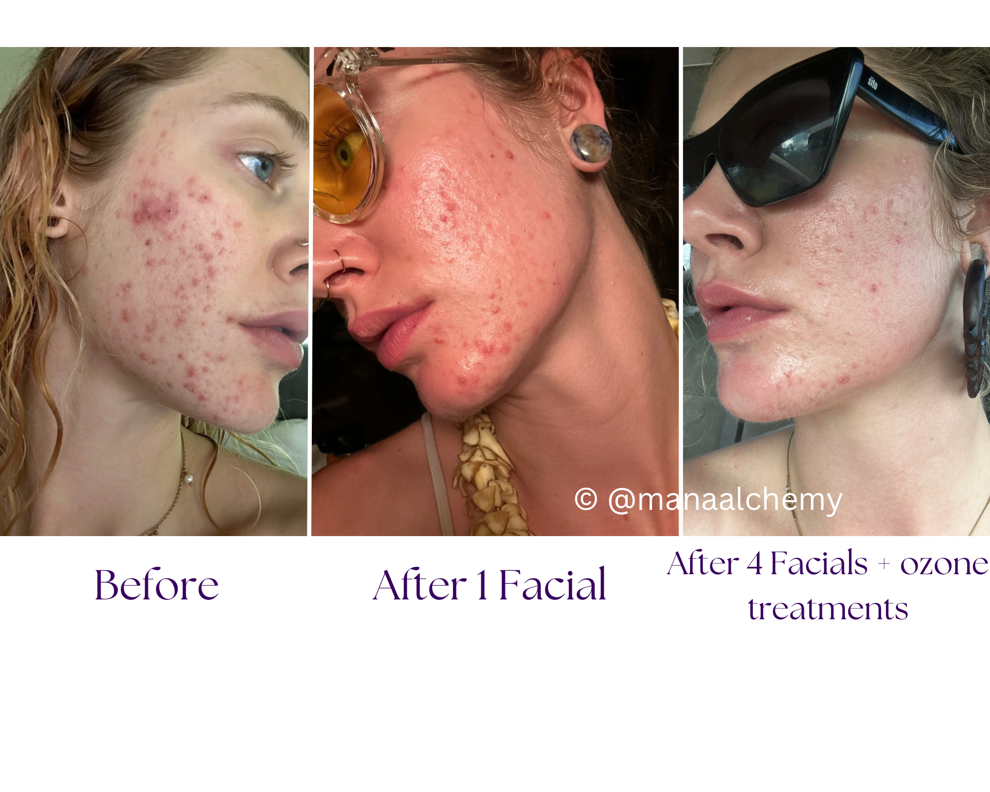 holistic acne solution kauai, skin care transformation kauai