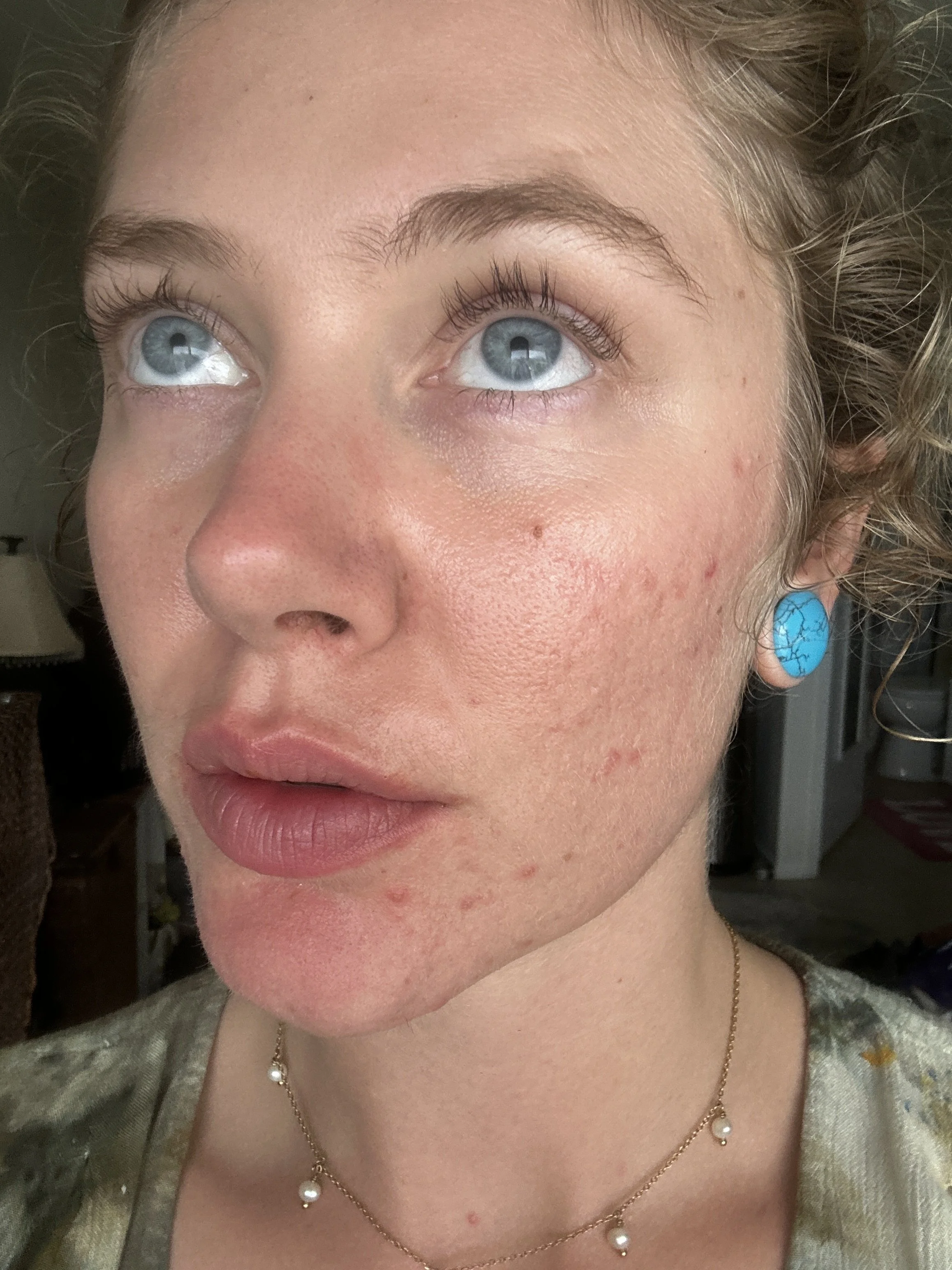 Acne healing kauai, holistic skin transformation
