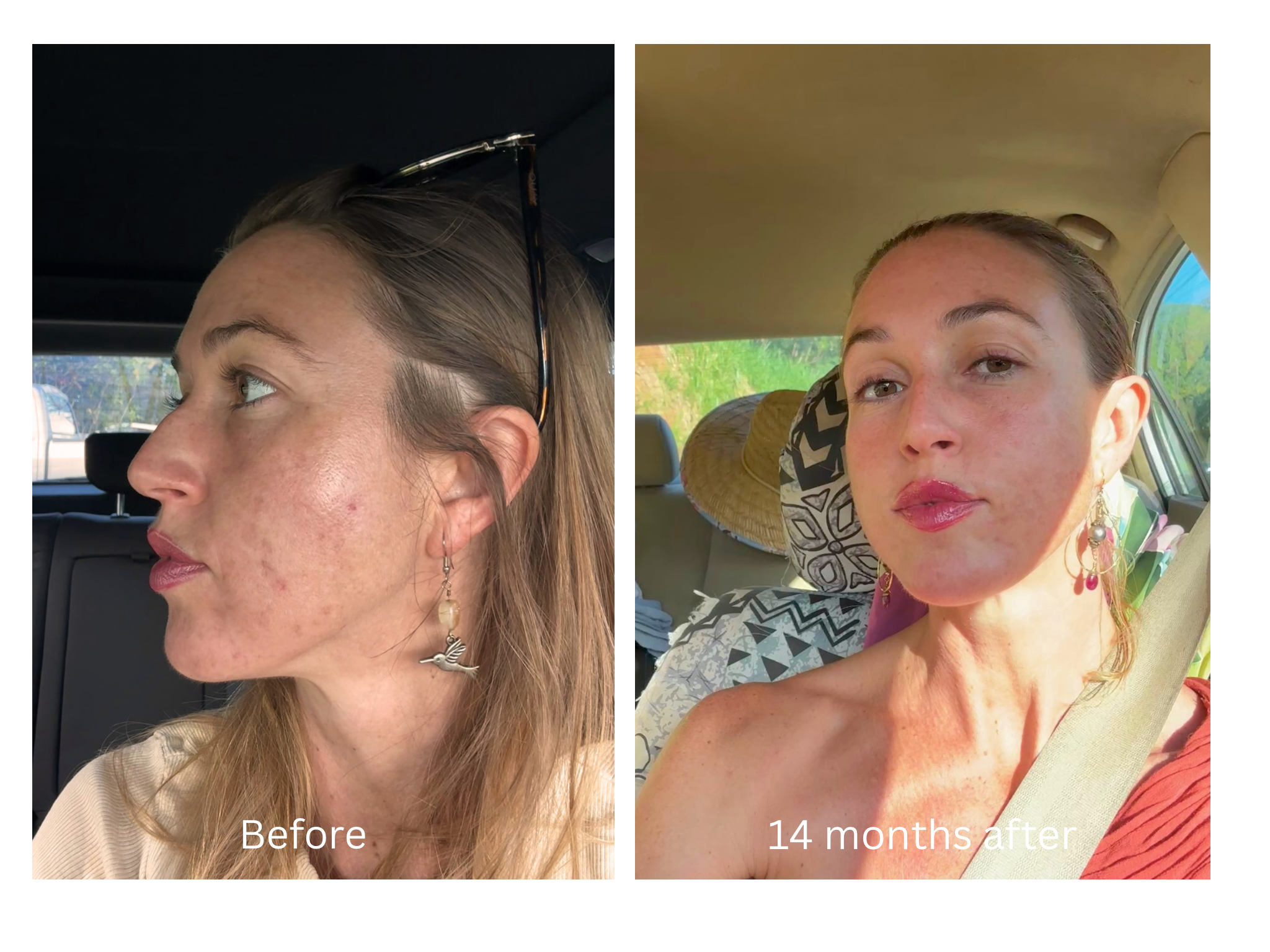 reveal healthy balanced skin acne treatment kauai