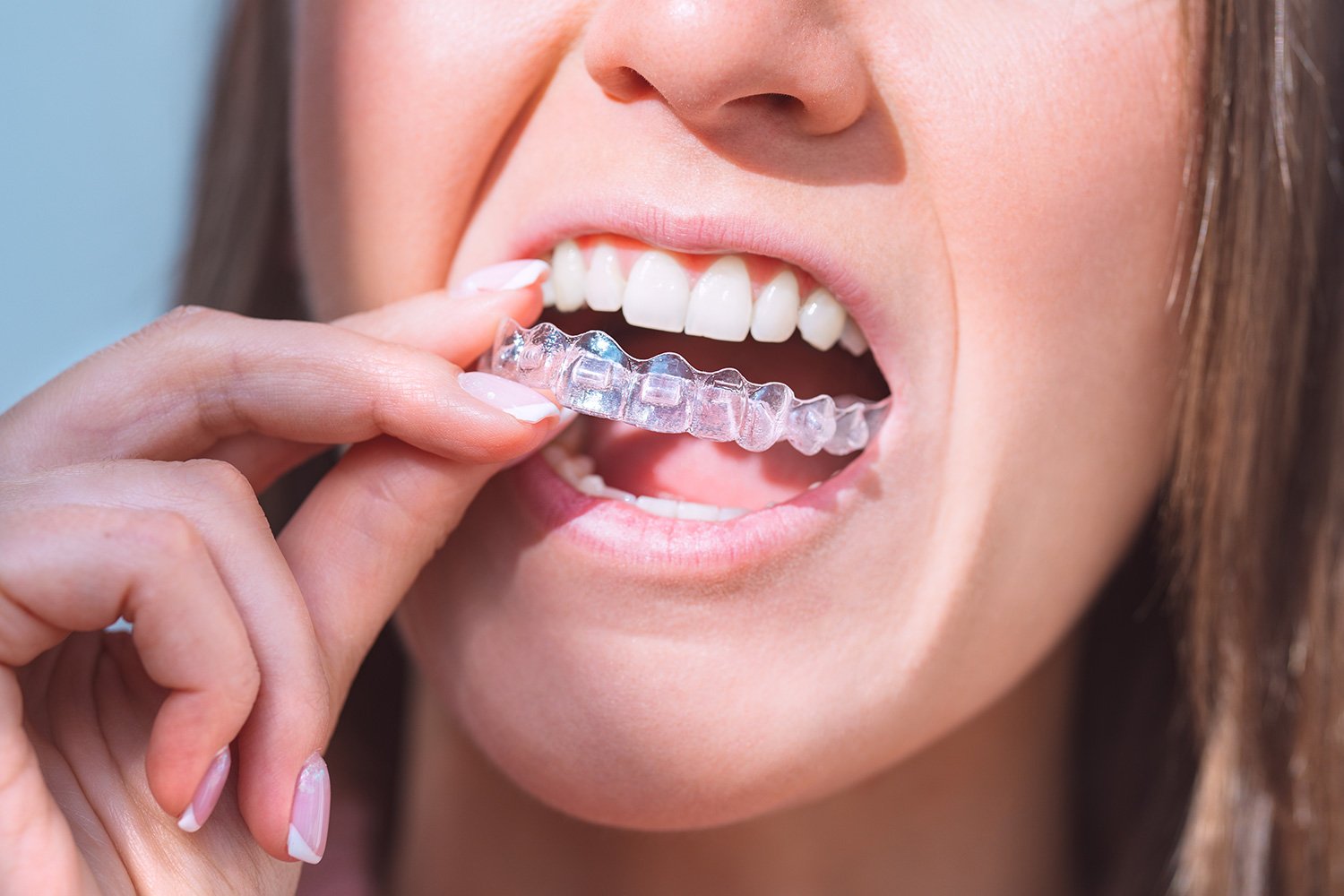 How to Care for New Clear Braces - Gateway Dental Ashburn Virginia