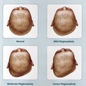 Understanding Positional Plagiocephaly: What Every Parent Should Know