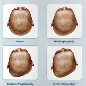 Understanding Positional Plagiocephaly: What Every Parent Should Know