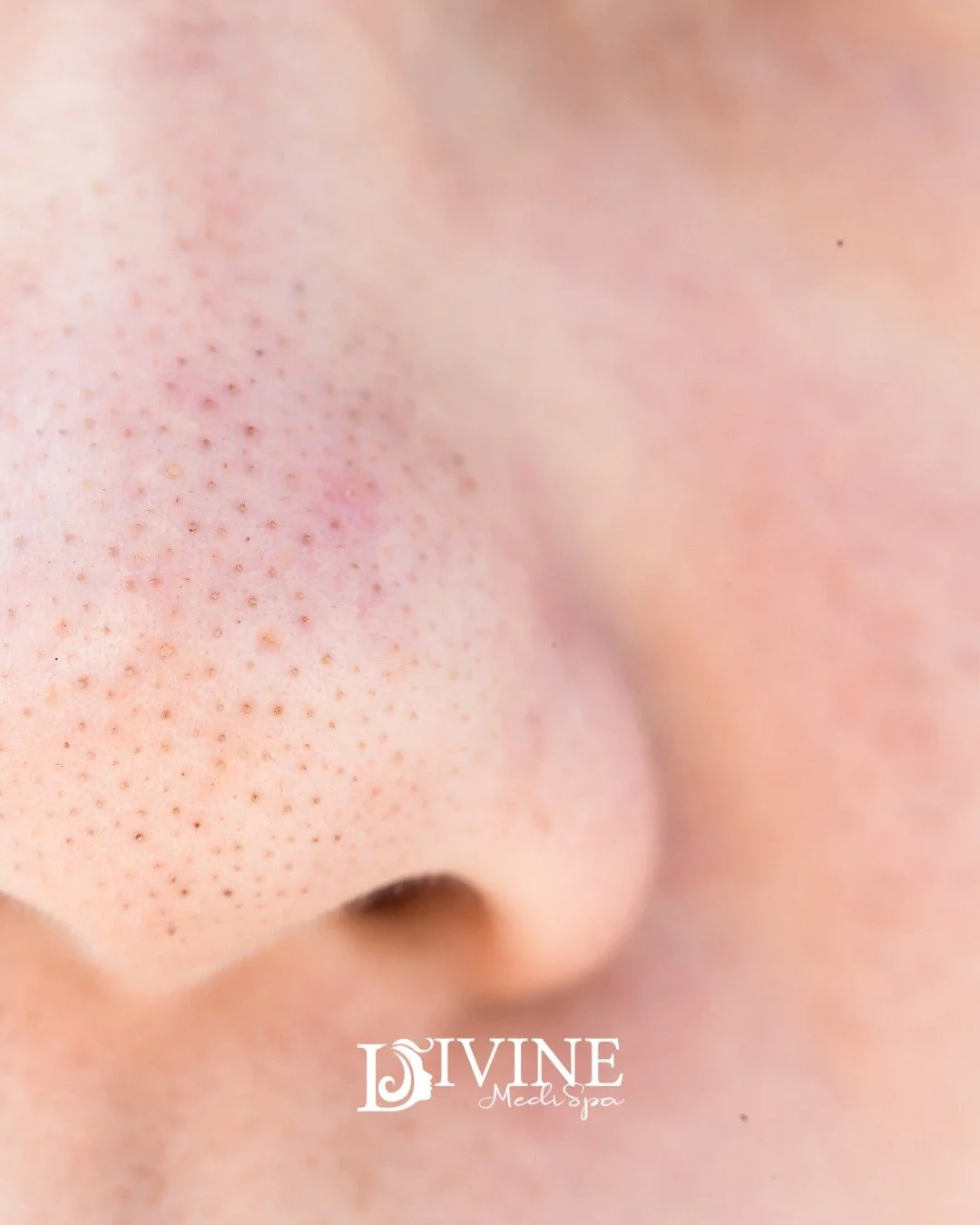 ZOOMED IN on Blackheads &amp; Congestion 🔍

Blackheads aren&rsquo;t dirt &mdash; they&rsquo;re oil and dead skin oxidized at the surface.

OxyGeneo medical facials + Noon Aesthetics Acne line  helps control oil production and has anti-bacterial acti