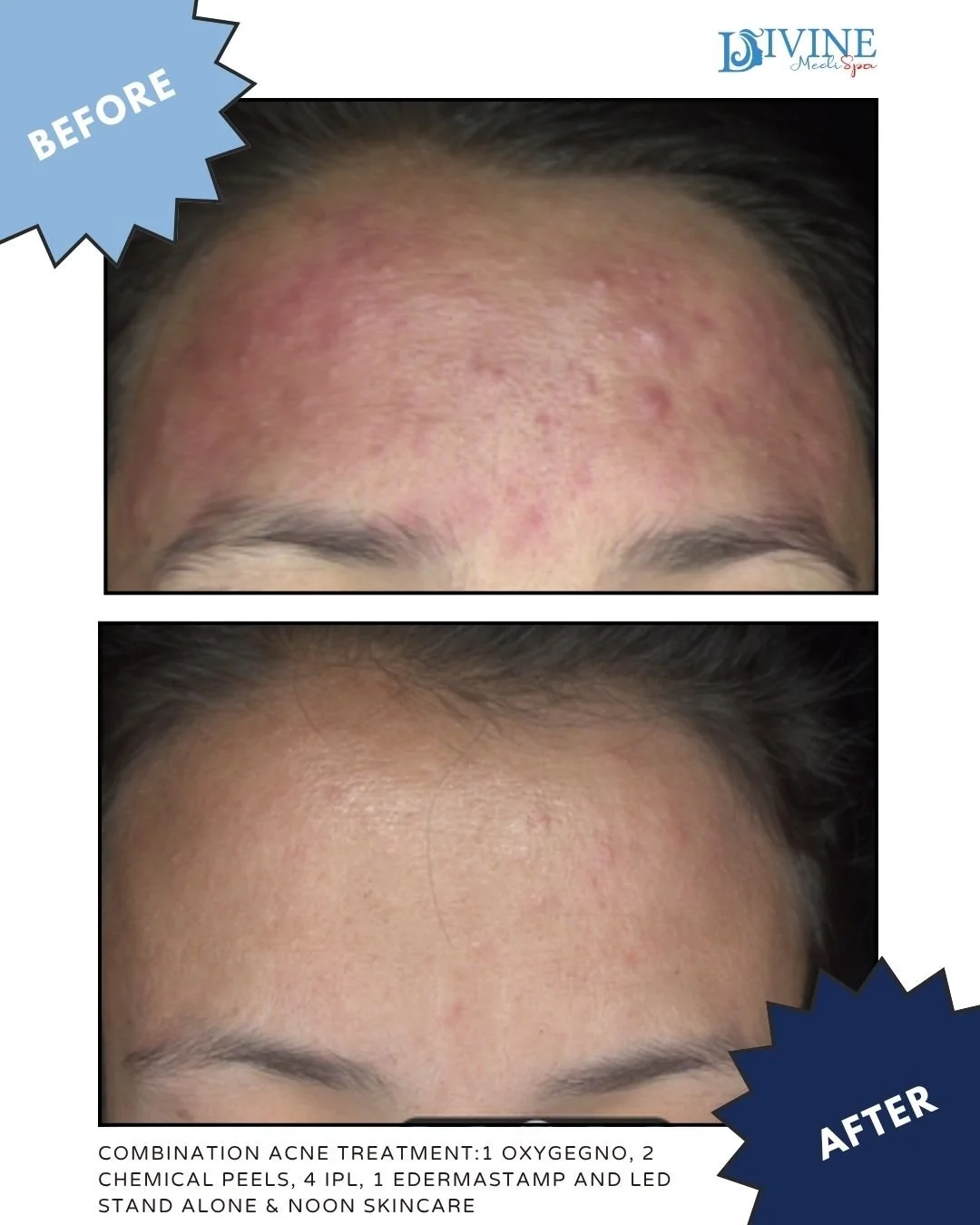 🔎 FOCUSED RESULTS: FOREHEAD TRANSFORMATION 🔎
After a customized combination of acne-fighting and skin-renewing treatments, this client saw a dramatic change in texture, breakouts, and pigmentation in this specific zone.
💆‍♀️ Treatment High