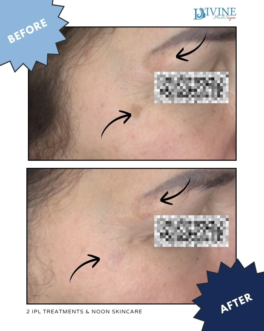 ✨ SPOTLIGHT ON PIGMENTATION: Targeted IPL Success ✨
⁣
This client focused on reducing stubborn pigmentation spots with just 2 targeted IPL treatments &mdash; and the results are already shining through!
⁣
🎯 Treatment Focus:
✔️ Precision IPL to break