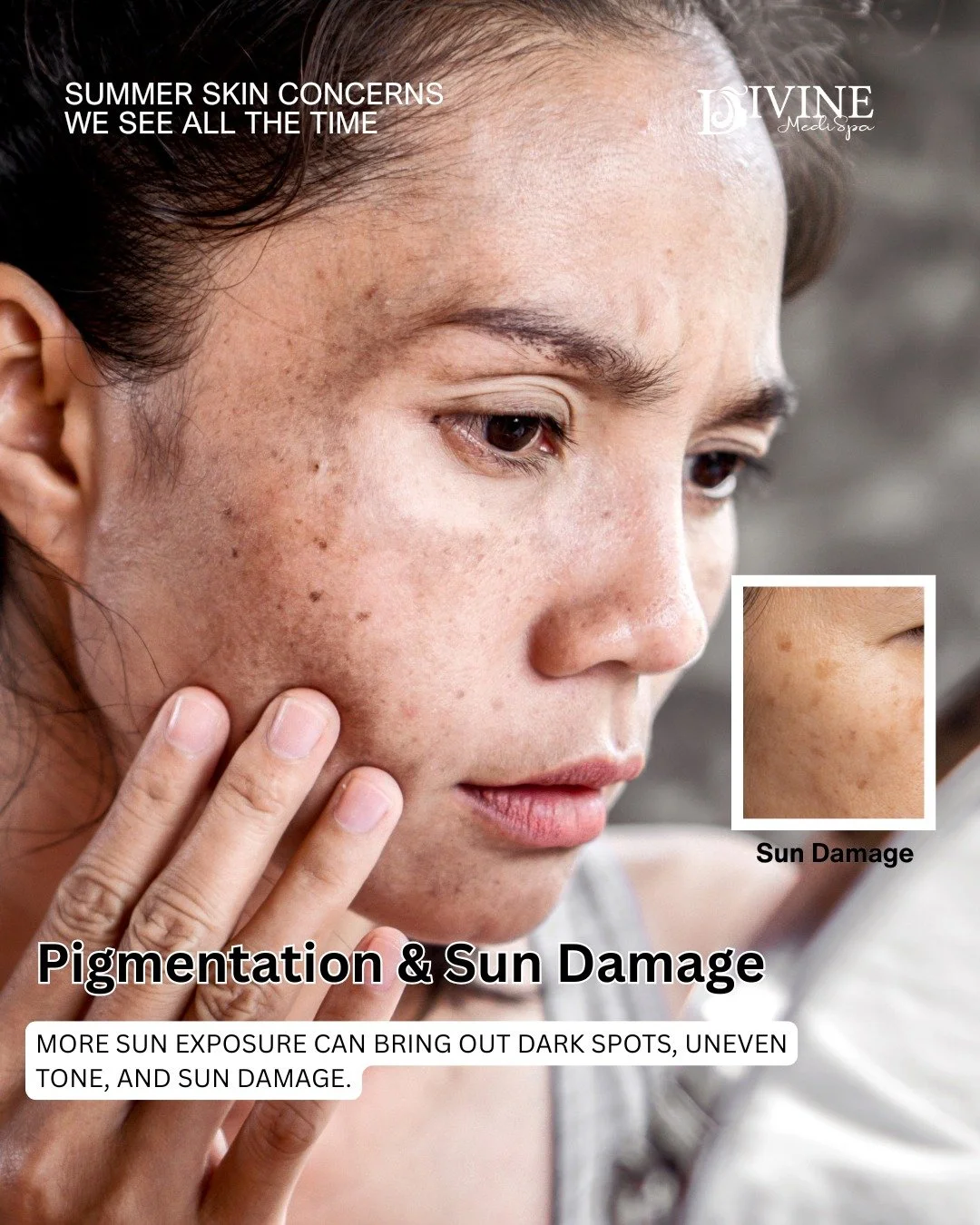 ☀️ SUMMER SKIN CONCERNS WE&rsquo;RE SEEING RIGHT NOW ☀️

Warmer weather can be amazing for the soul&hellip; but not always for your skin 😅

Heat, humidity, sweat, sun exposure, and dehydration can all lead to changes in your skin throughout the summ
