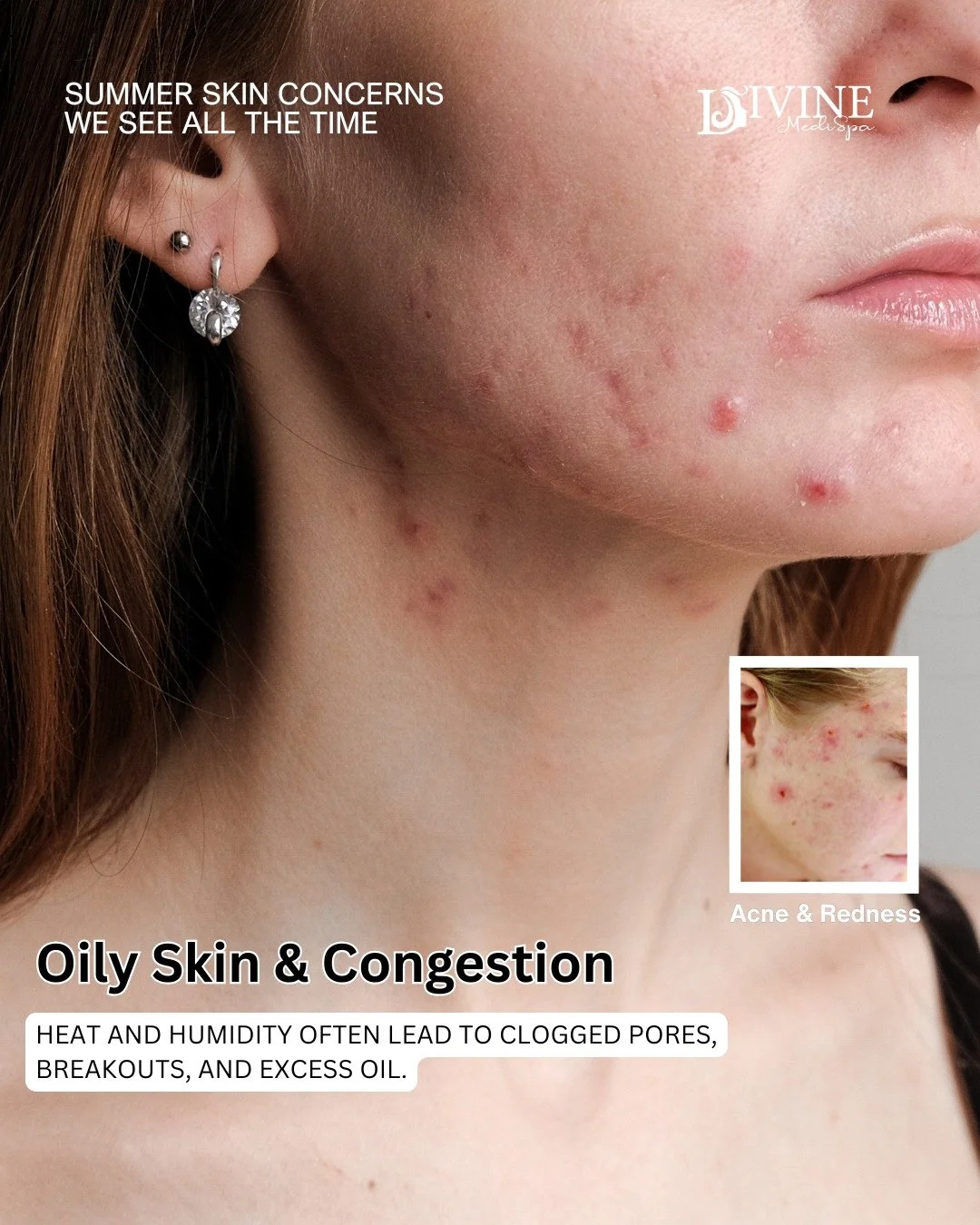 ☀️ YOUR SKIN CHANGES IN THE SUMMER &mdash; AND THAT&rsquo;S NORMAL ☀️

With more sun exposure, humidity, sweating, travel, and time outdoors, we tend to see certain skin concerns become much more common during the summer months.

✨ Treatments we love