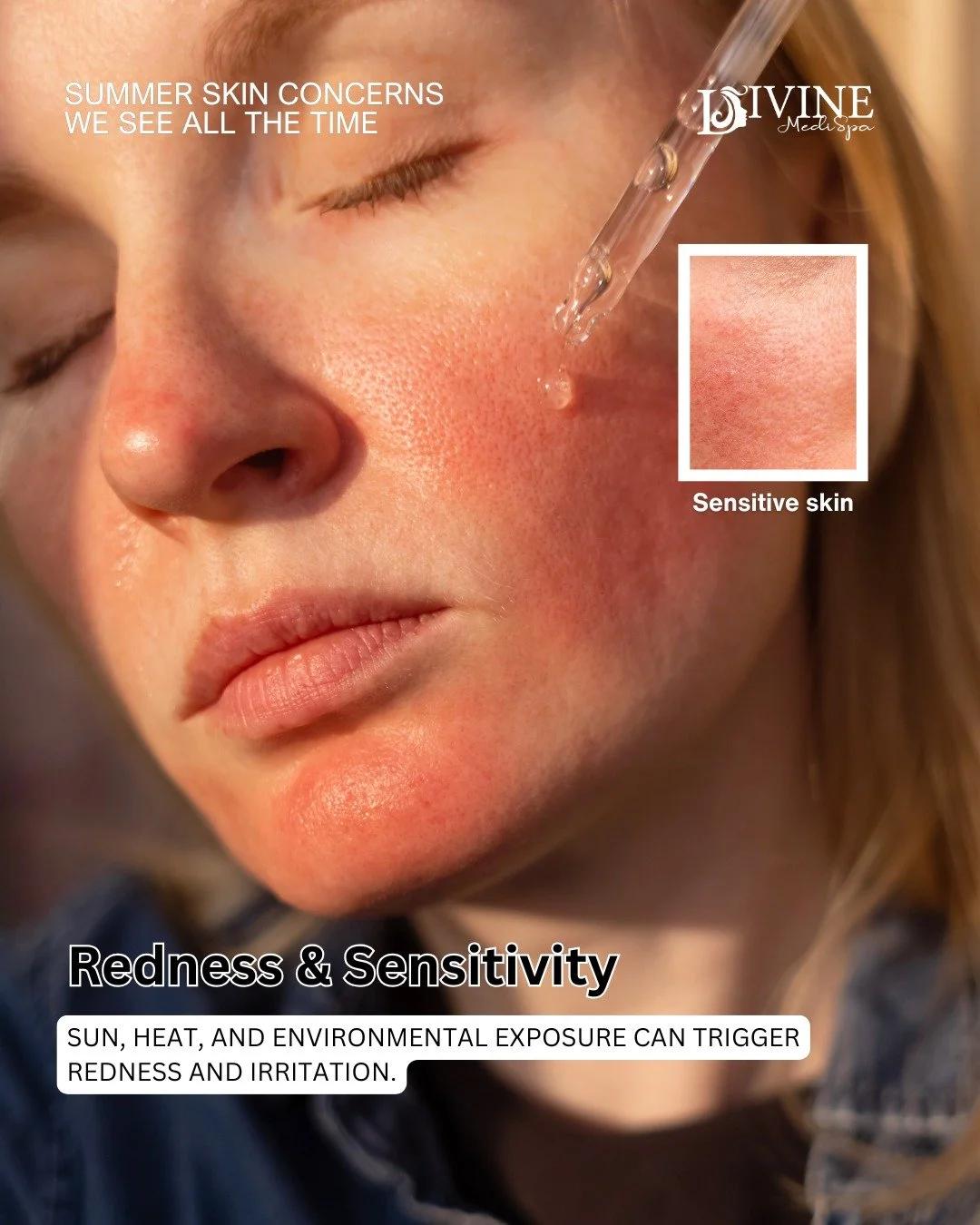 ☀️ SUMMER CAN BE HARD ON YOUR SKIN ☀️
Long days in the sun, heat, humidity, and air conditioning can all take a toll on your skin during the summer months.

✨ Treatments we love for red and sensitive skin:
 &bull; IPL for redness
 &bull; Hydrating Ox