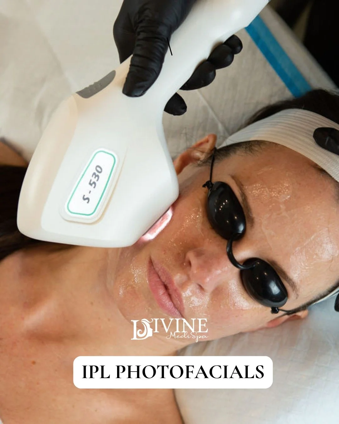 Looking to target sun damage, redness, pigmentation, or uneven skin tone? Our IPL Photofacials can help reveal brighter, clearer, more even-looking skin 

IPL works by using pulses of light to target:
 ✔️ Sun spots &amp; pigmentation
 ✔️ Redness &amp