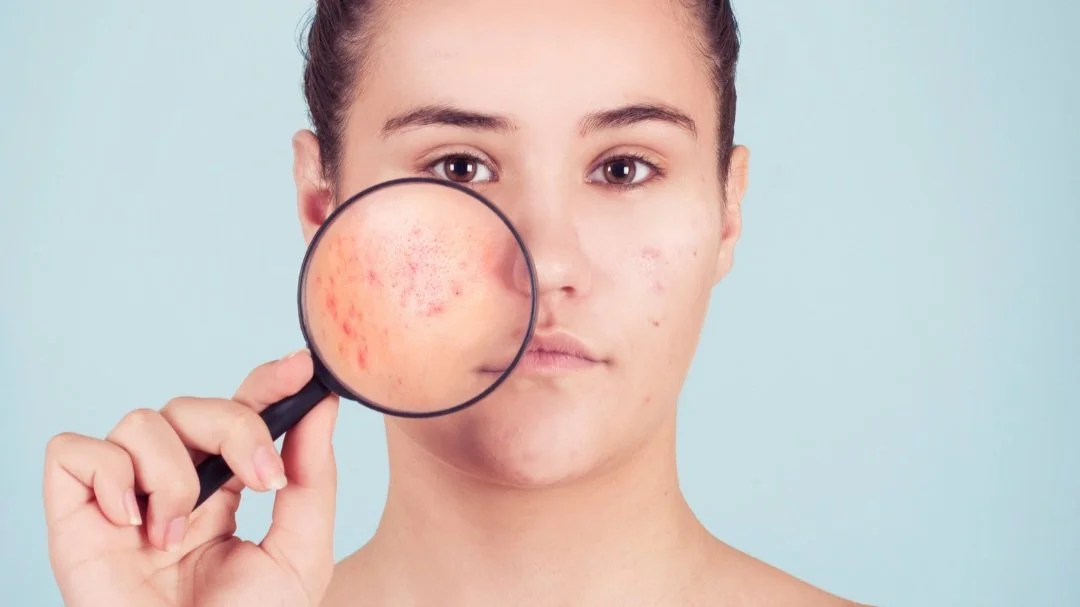 June is Acne Awareness Month! — Divine MediSpa