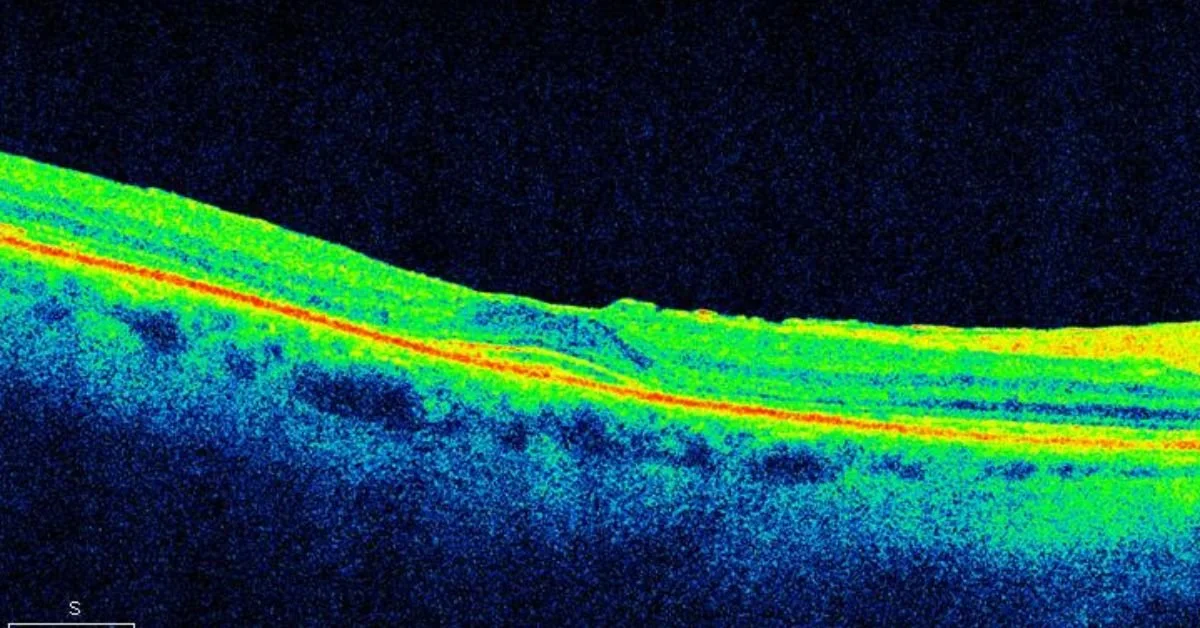 Problem. Oct Scans 3D OCT Eye Exams | Early Detection of Glaucoma, AMD, & Diabetic Retinopathy