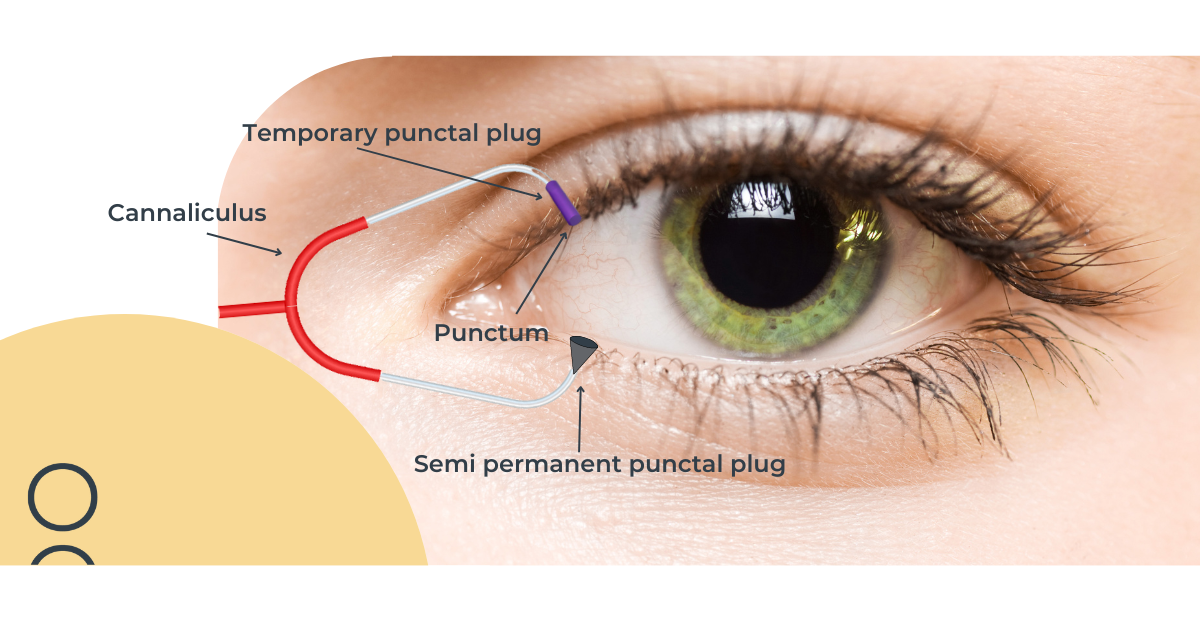 Risks Of Punctal Plugs For Dry Eyes at Herman Lyons blog
