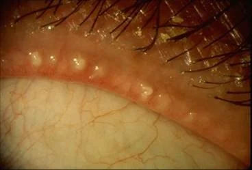 Close-up of inflamed human eyelid with clogged glands