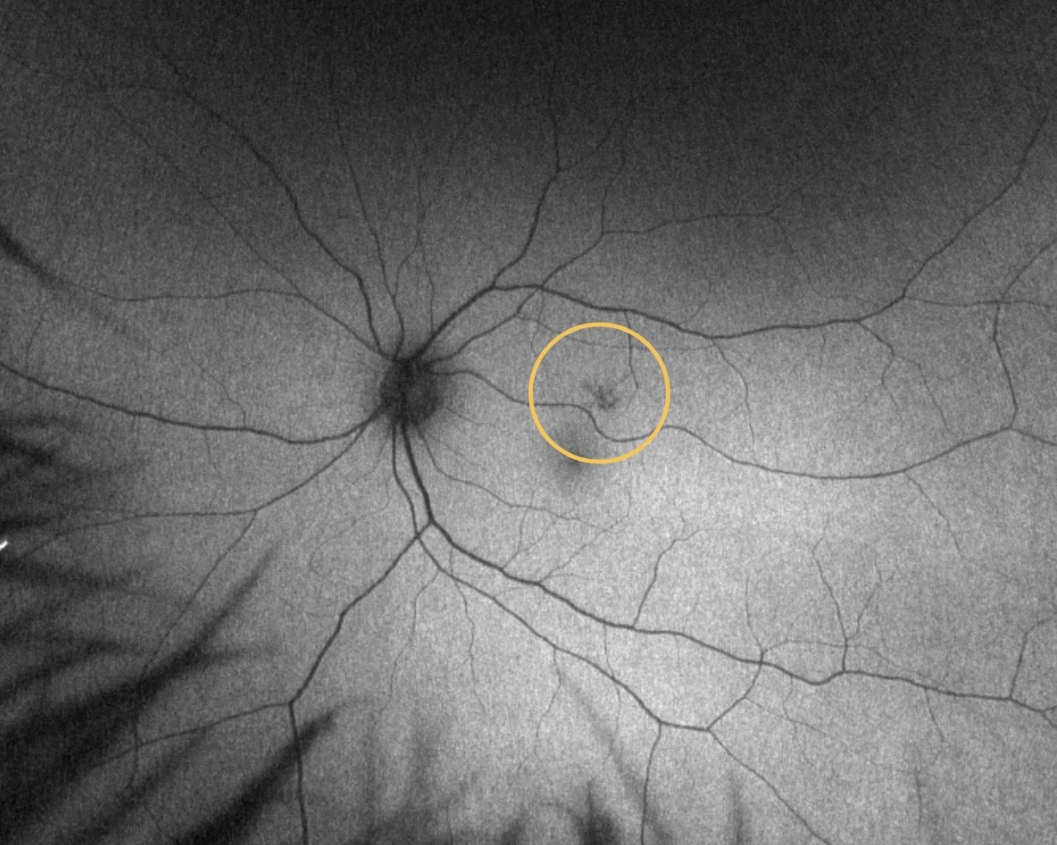Optomap Ultra Widefield Retinal Imaging
