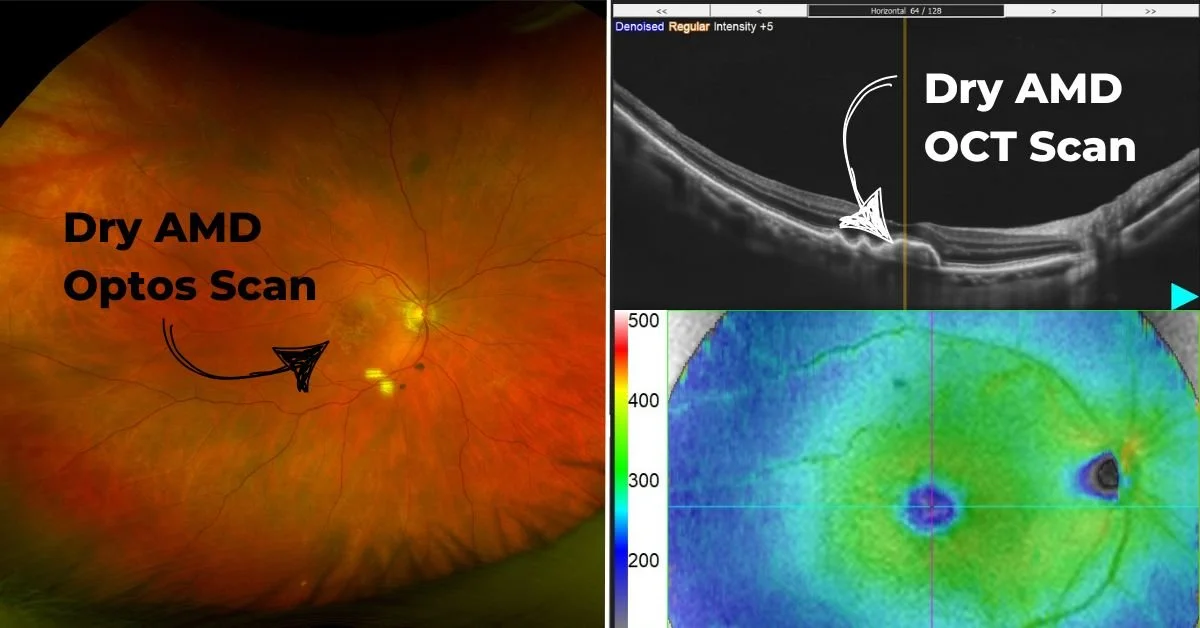 Age-Related Macular Degeneration