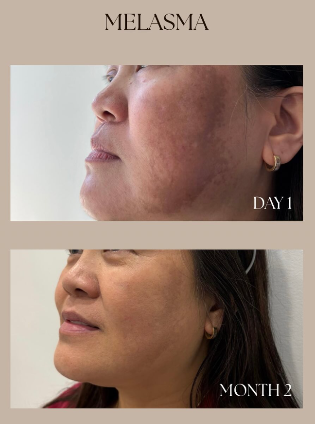 Melasma Case Study: A Personalised Clinical Approach to Pigmentation at AMRÉ