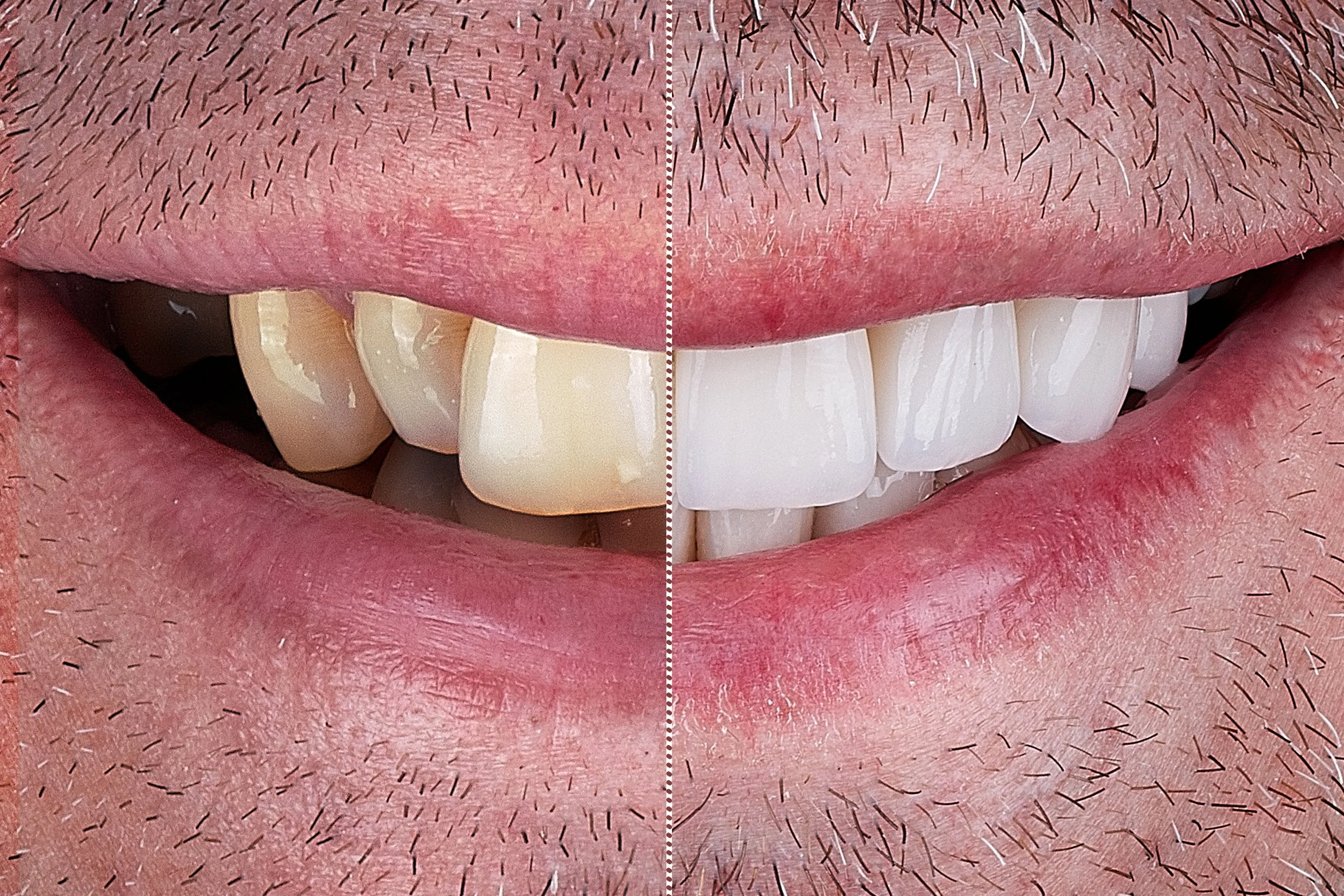 Considering Composite Bonding? Read This First